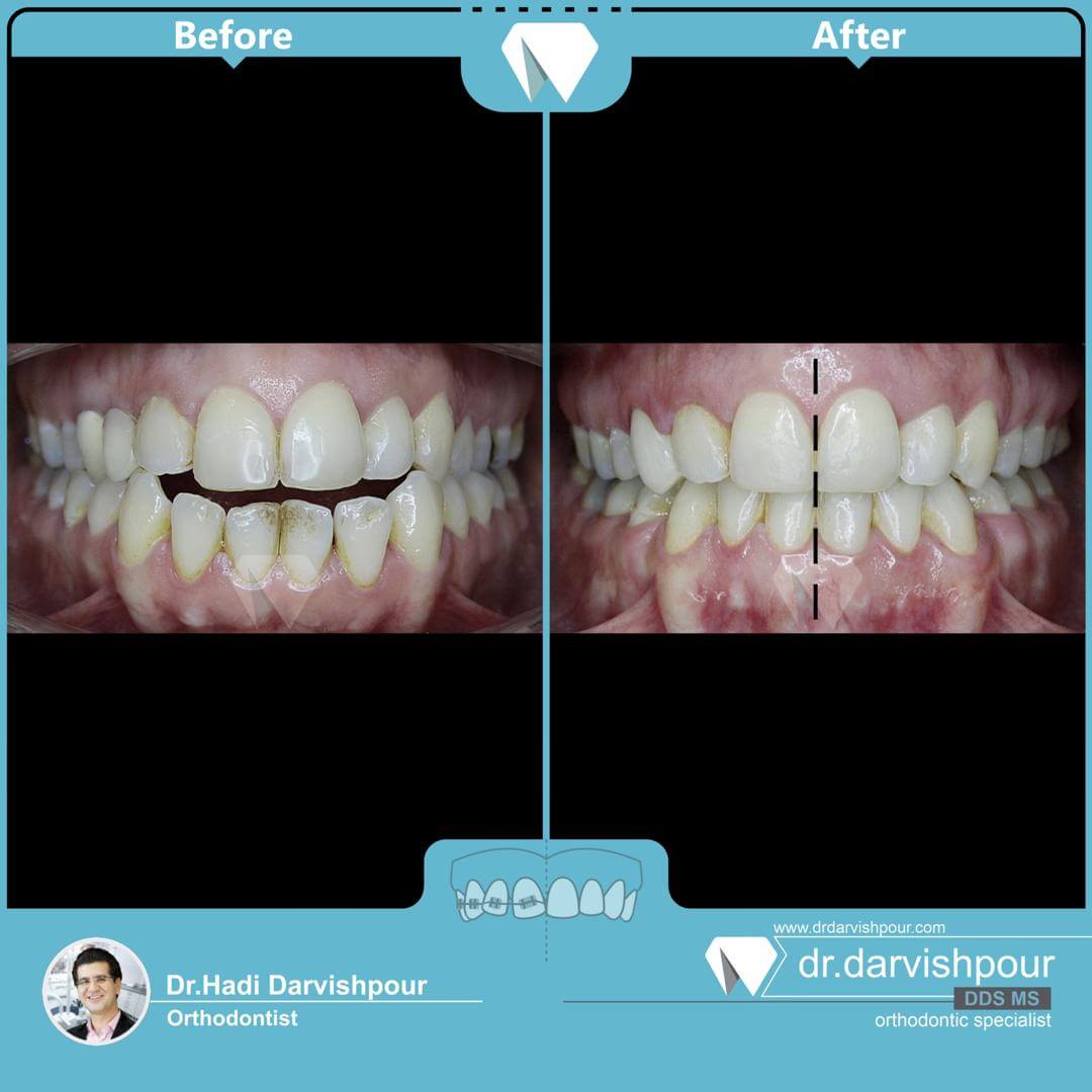 1758orthodontics-before-after-photo