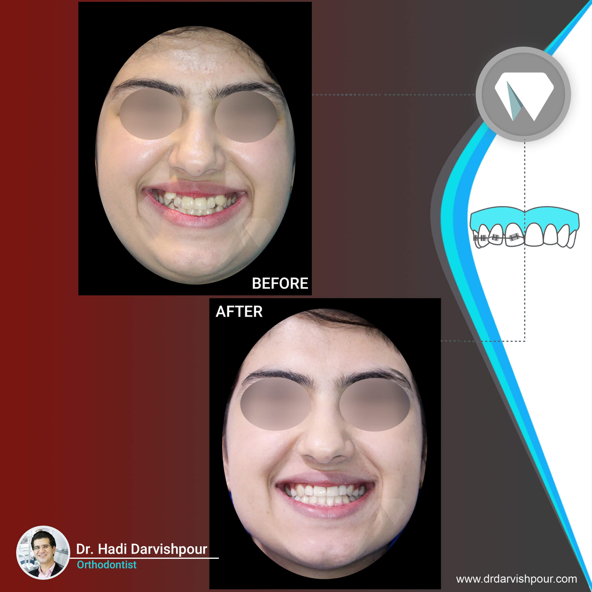 1764orthodontics-before-after-photo