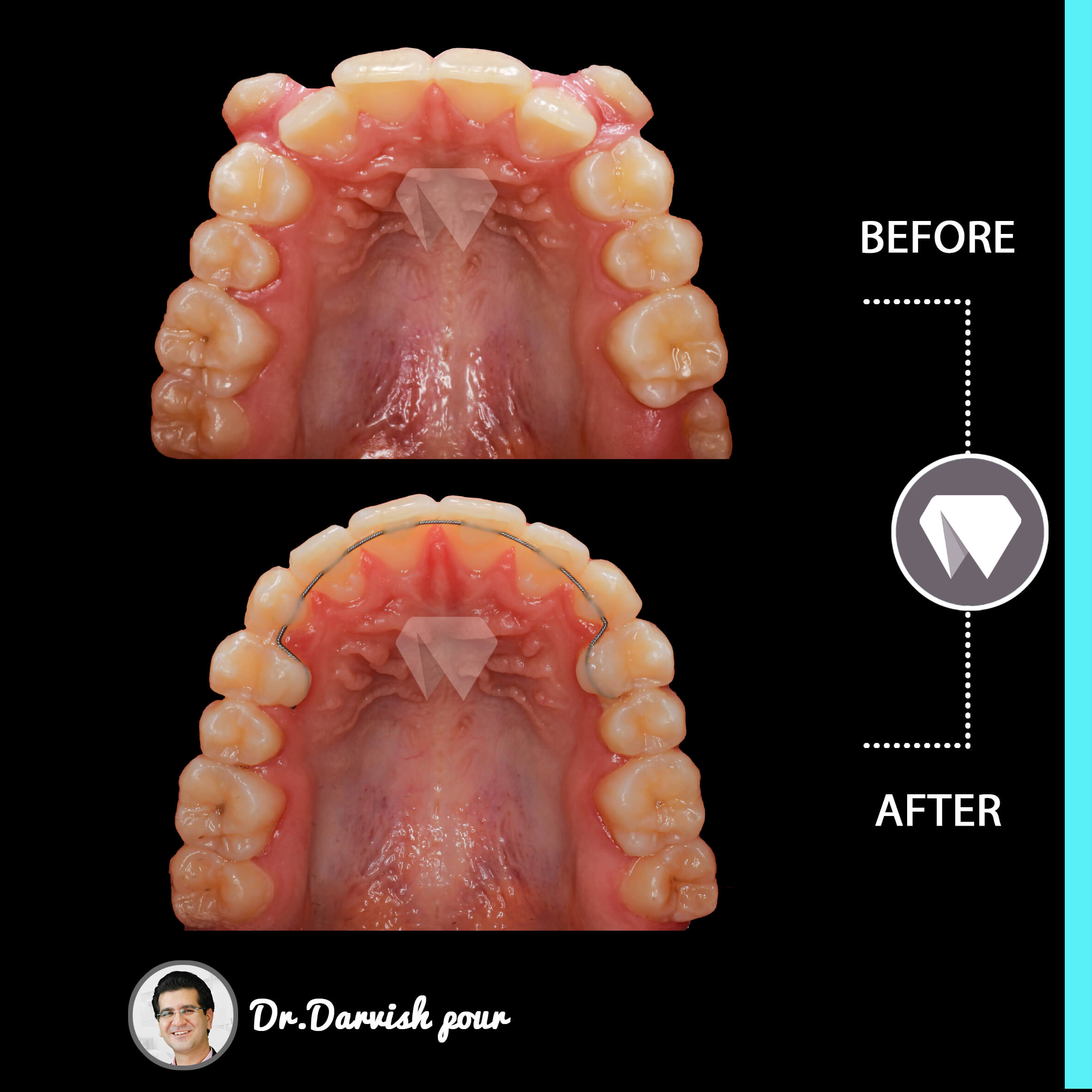 1781orthodontics-before-after-photo