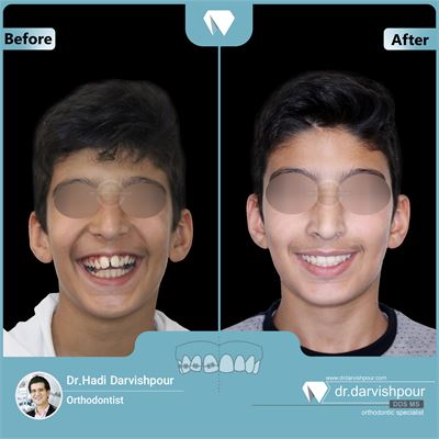 ارتودنسی متحرک فانکشنال و متعاقبا ارتودنسی ثابت دو فک بدون کشیدن دندان