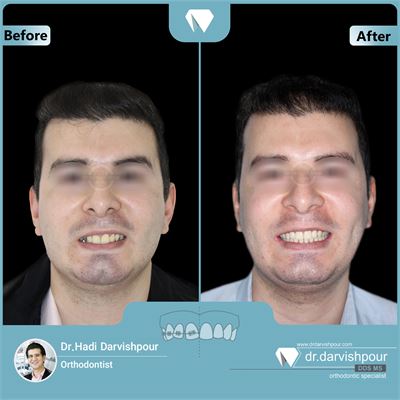 درمان ارتودنسی ثابت بدون جراحی فک و بدون کشیدن دندان