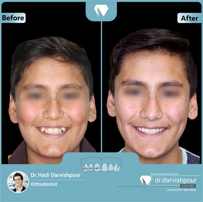 درمان ارتودنسی ثابت بدون جراحی فک و با کشیدن دندان