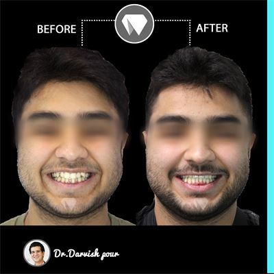 درمان ارتودنسی ثابت دو فک همراه با کشیدن دندان