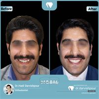 درمان ارتودنسی ثابت بدون جراحی فک و با کشیدن دندان