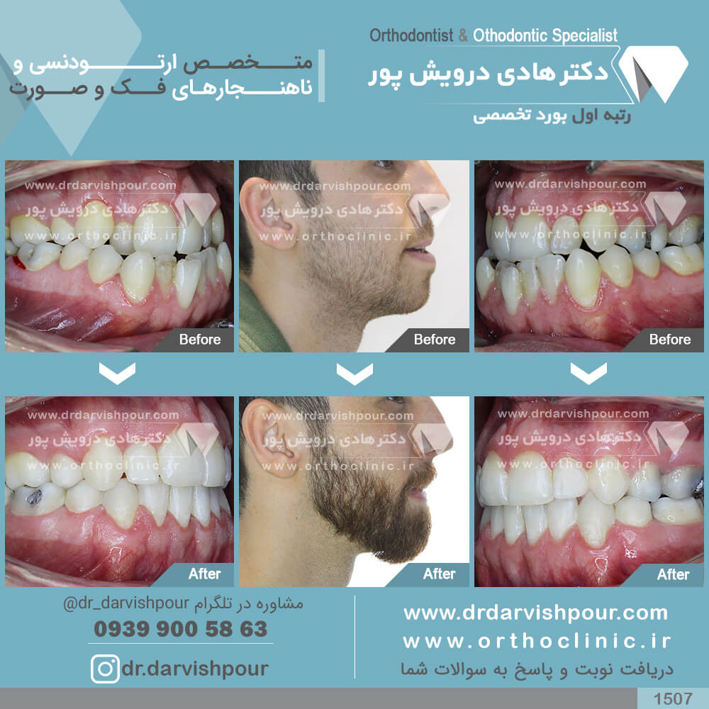 1507orthodontics-before-after-photo