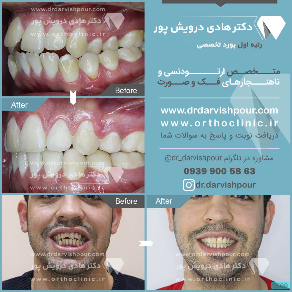 1509orthodontics-before-after-photo
