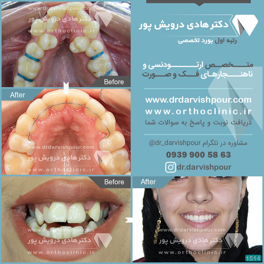 1514orthodontics-before-after-photo