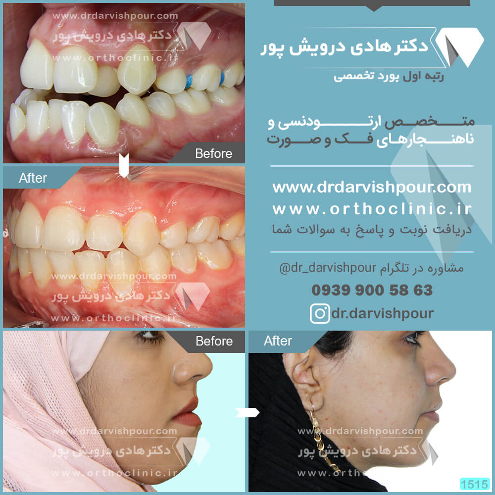 1515orthodontics-before-after-photo