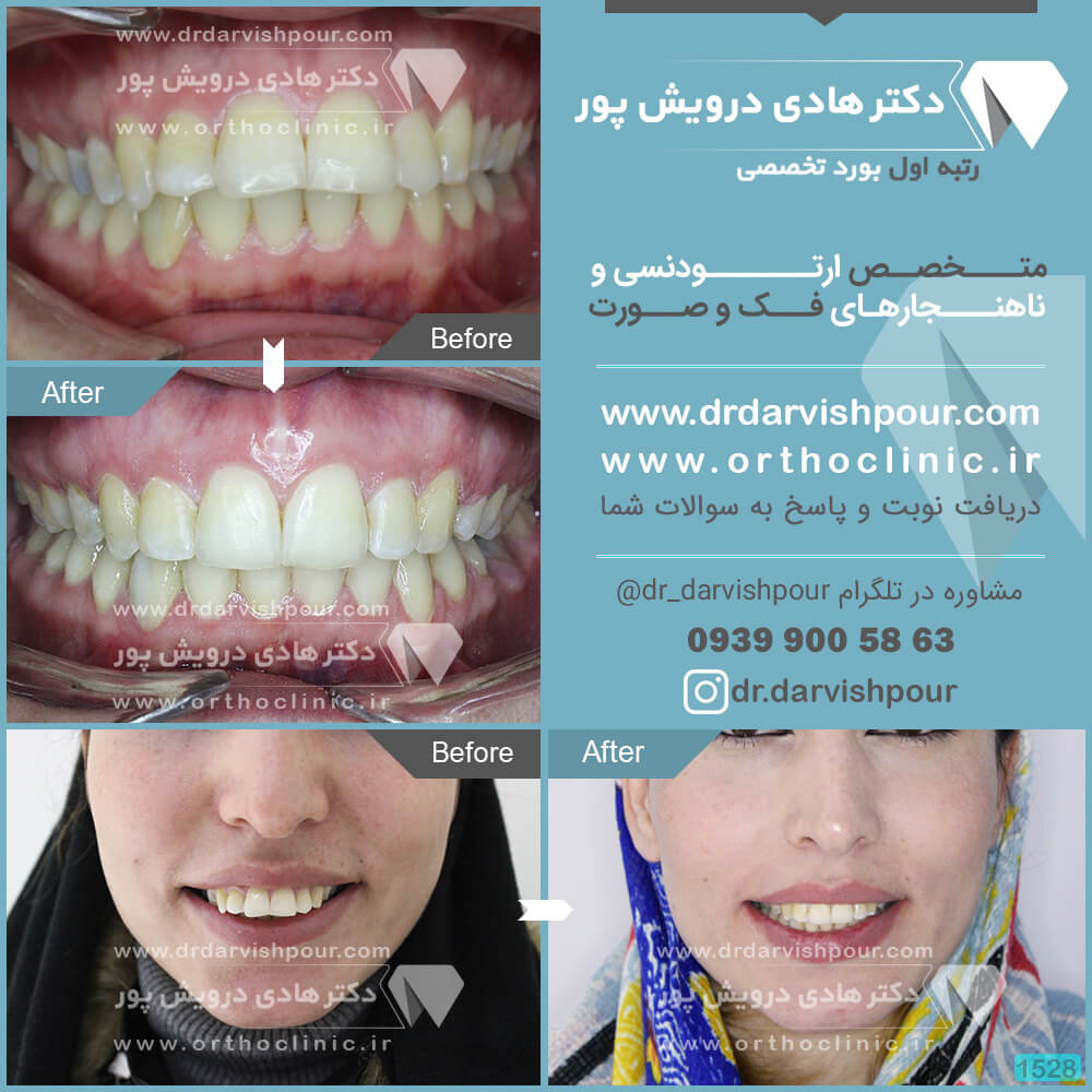 1528orthodontics-before-after-photo