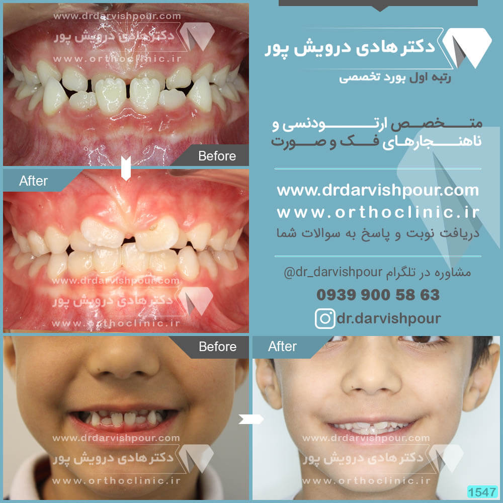 1547orthodontics-before-after-photo