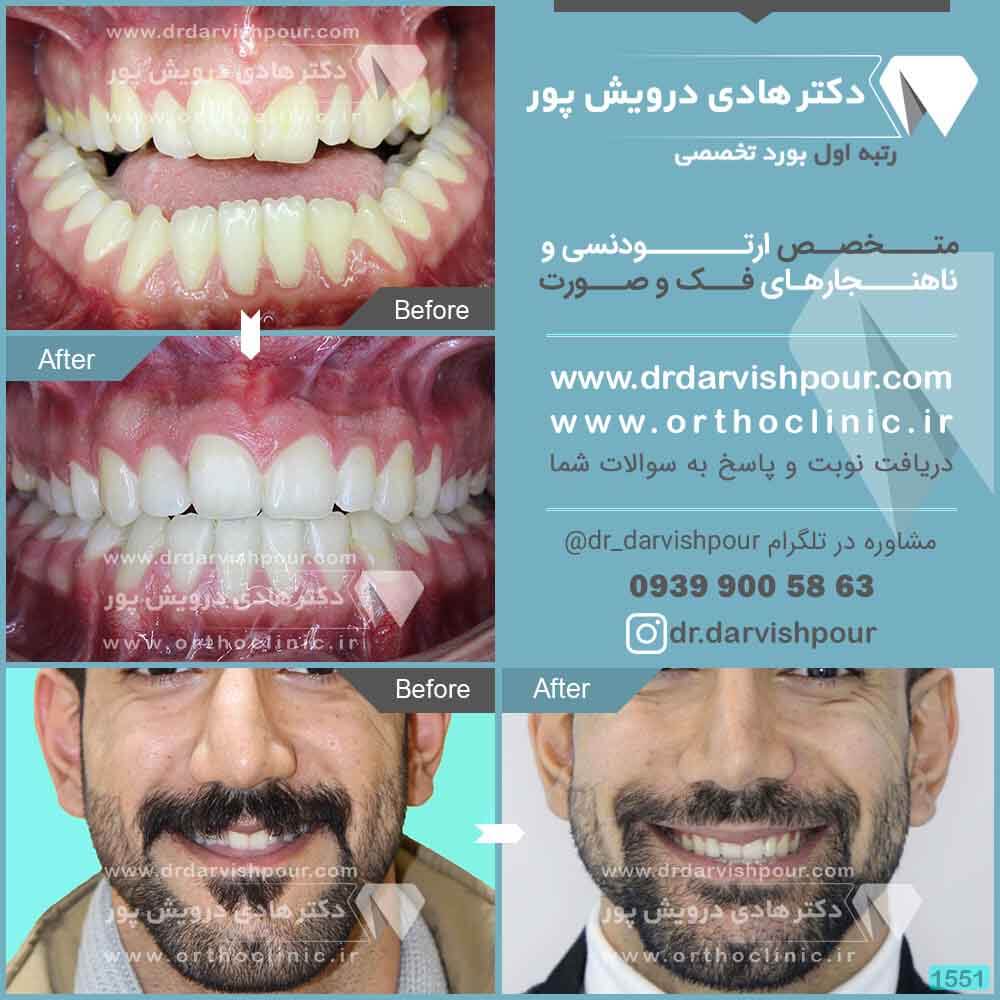 1551orthodontics-before-after-photo