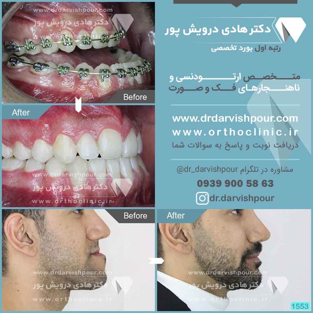 1553orthodontics-before-after-photo