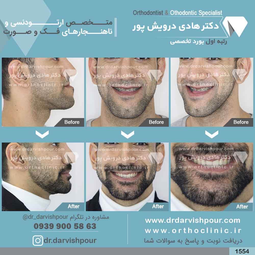 1554orthodontics-before-after-photo