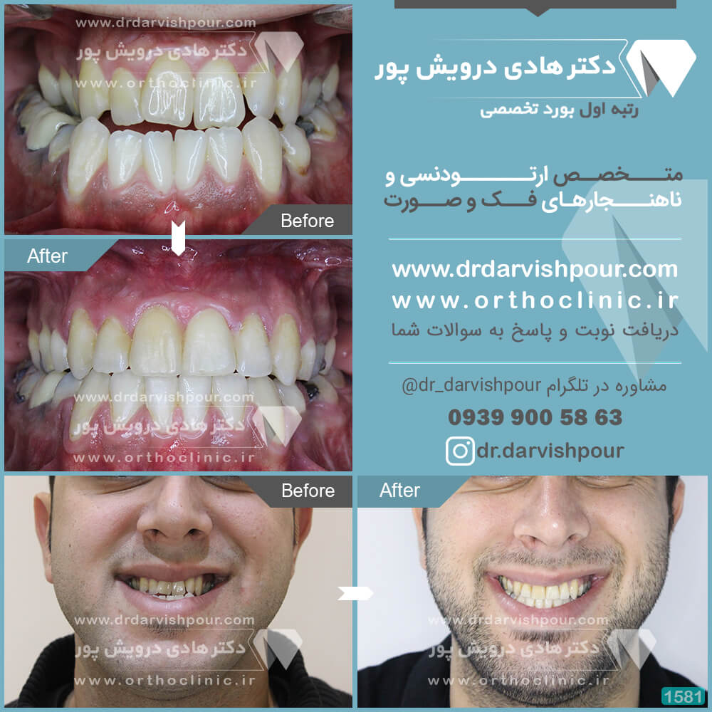 1581orthodontics-before-after-photo