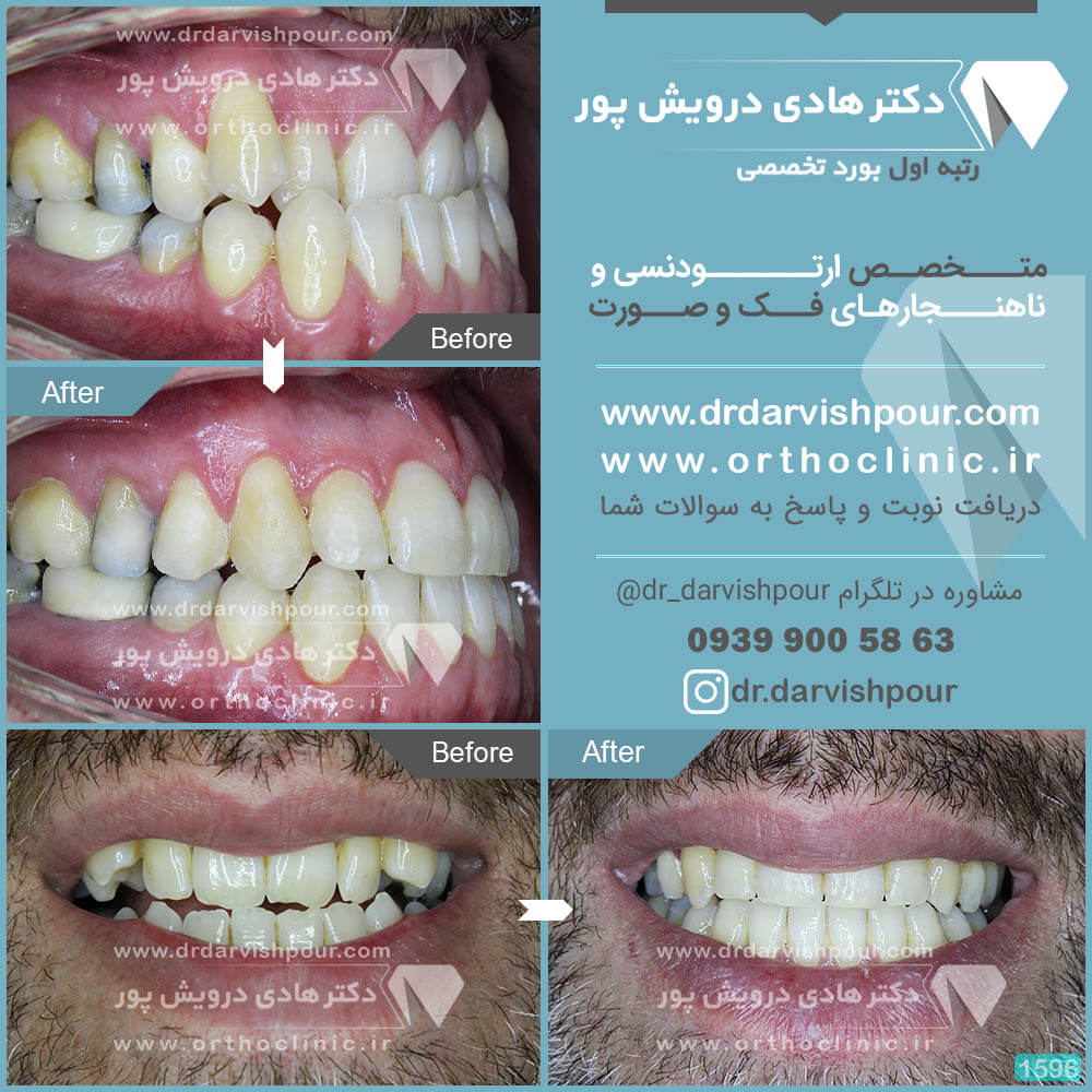 1596orthodontics-before-after-photo