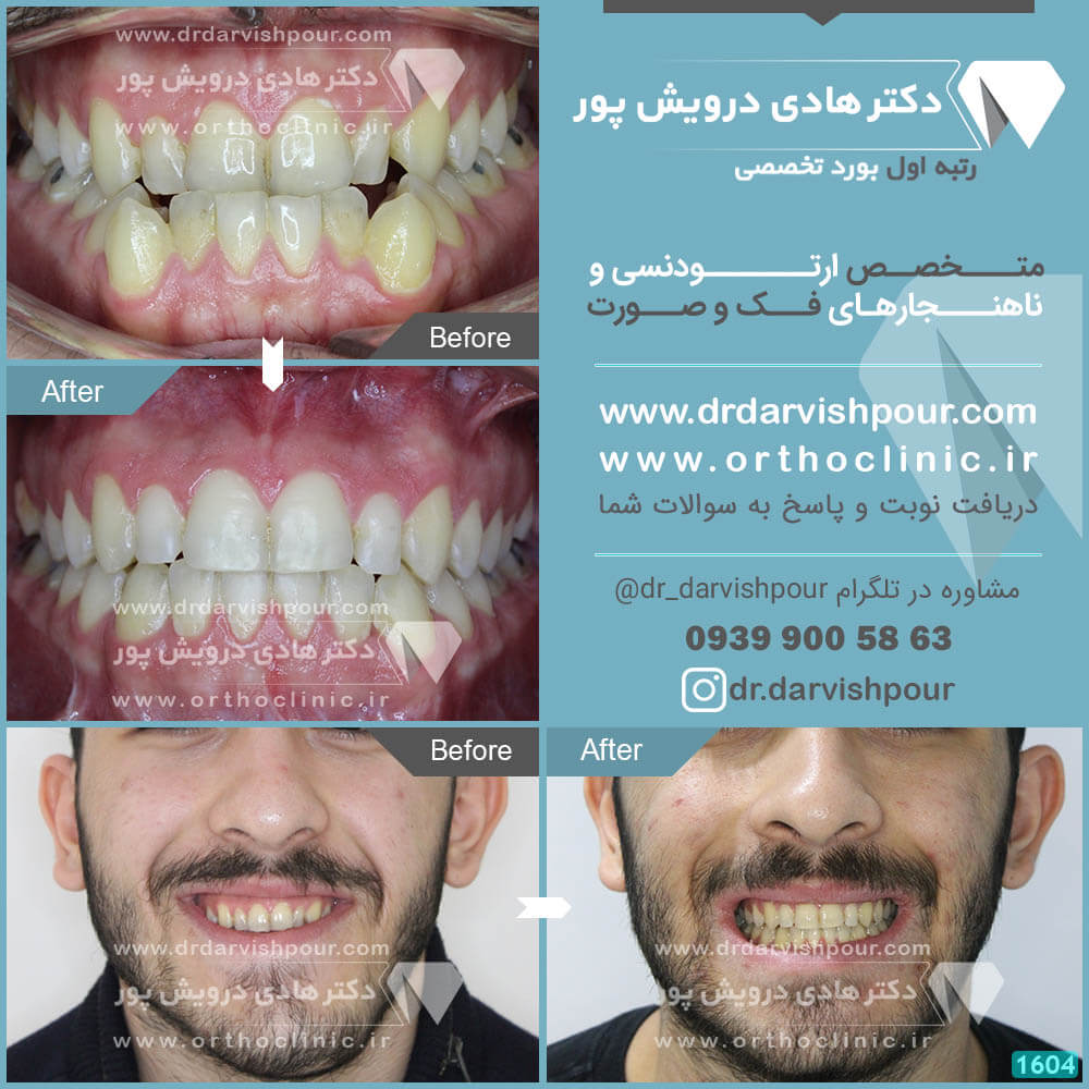 1604orthodontics-before-after-photo