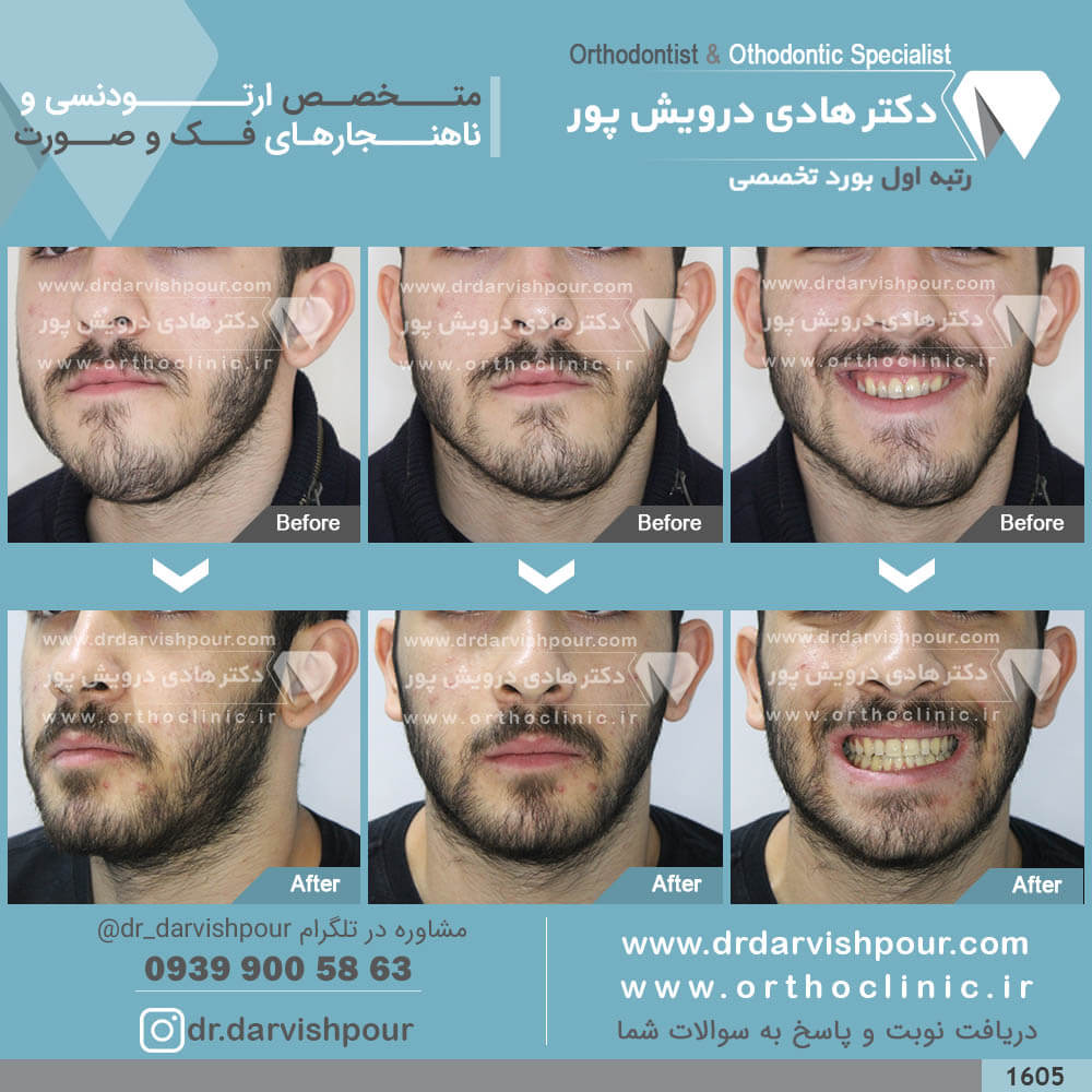 1605orthodontics-before-after-photo