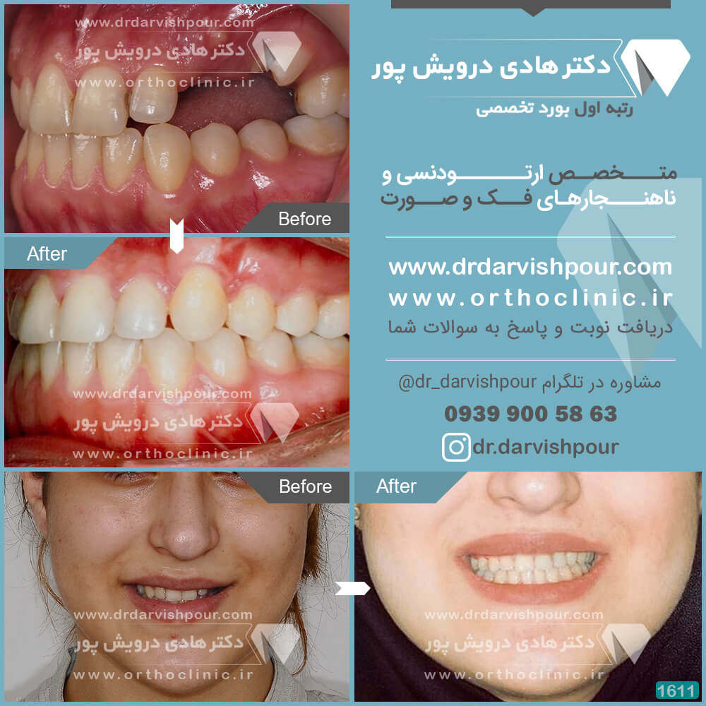 1611orthodontics-before-after-photo