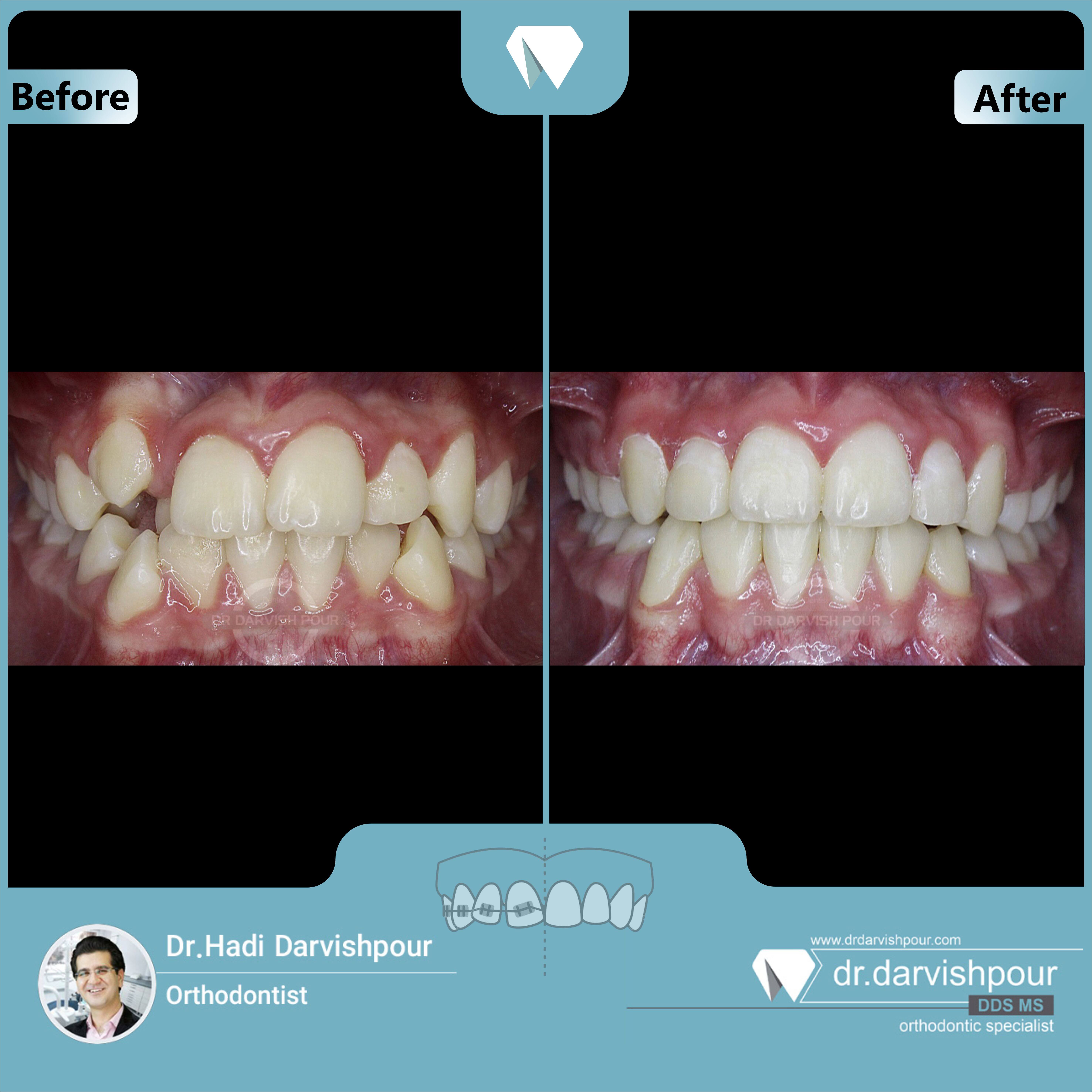 1644orthodontics-before-after-photo
