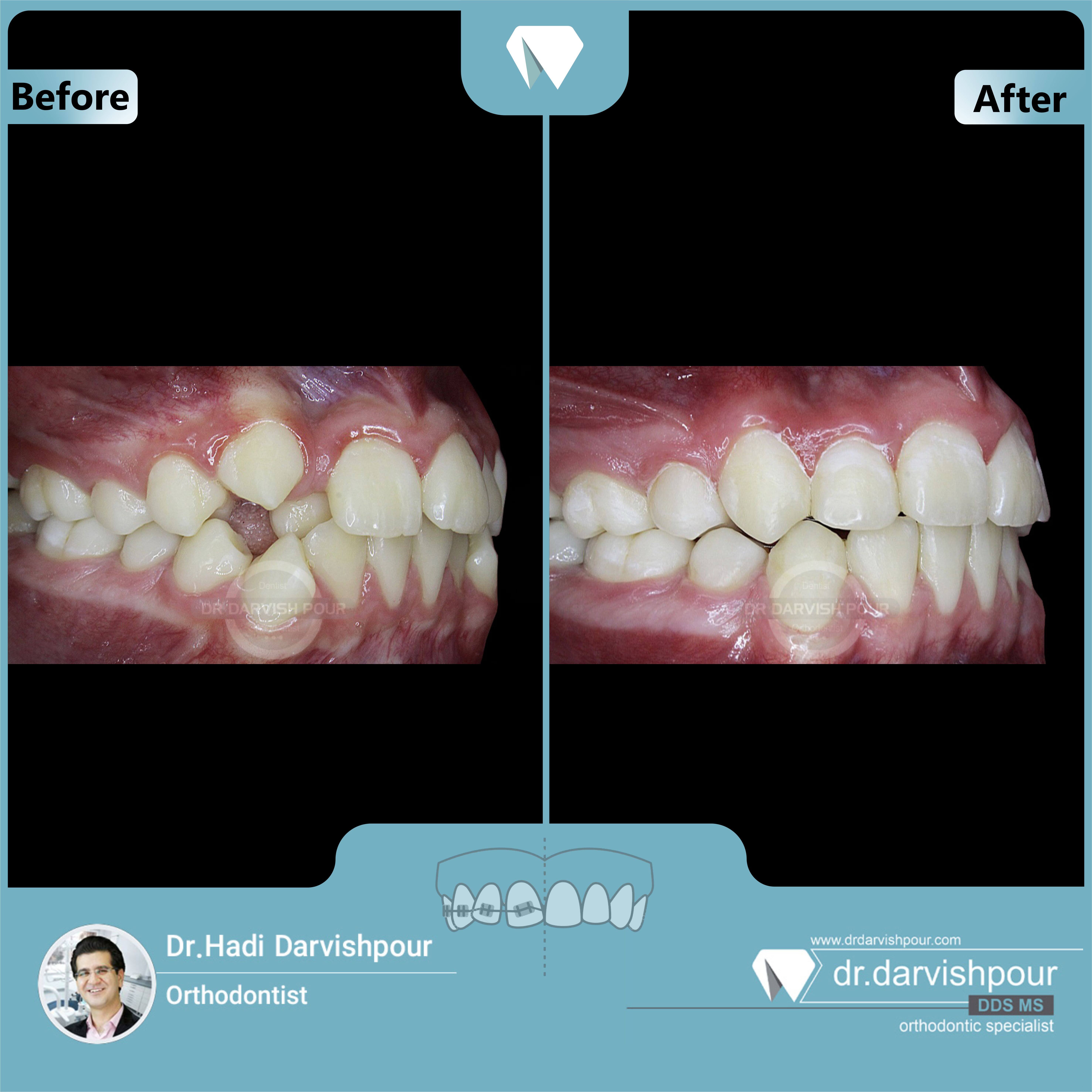 1645orthodontics-before-after-photo