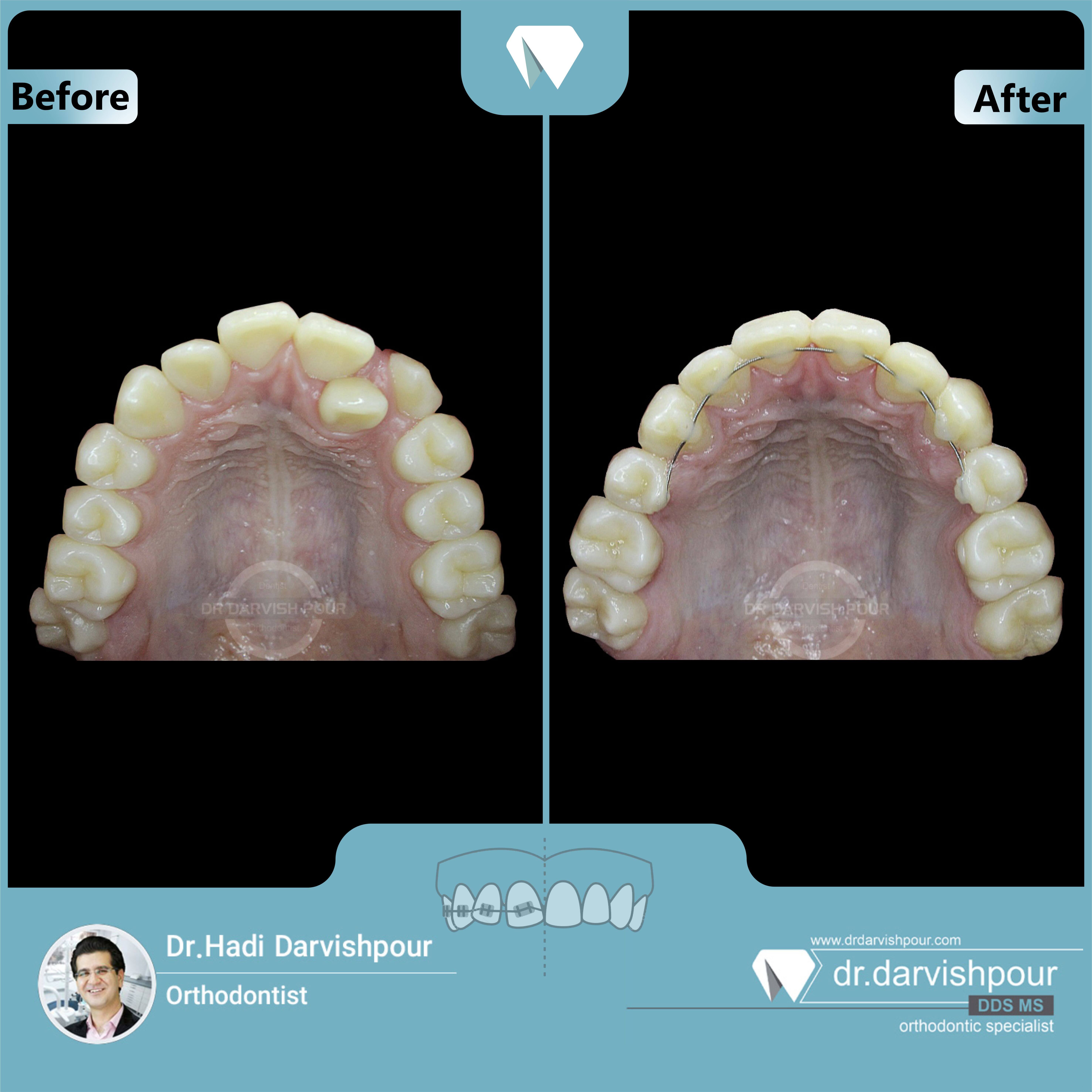 1646orthodontics-before-after-photo
