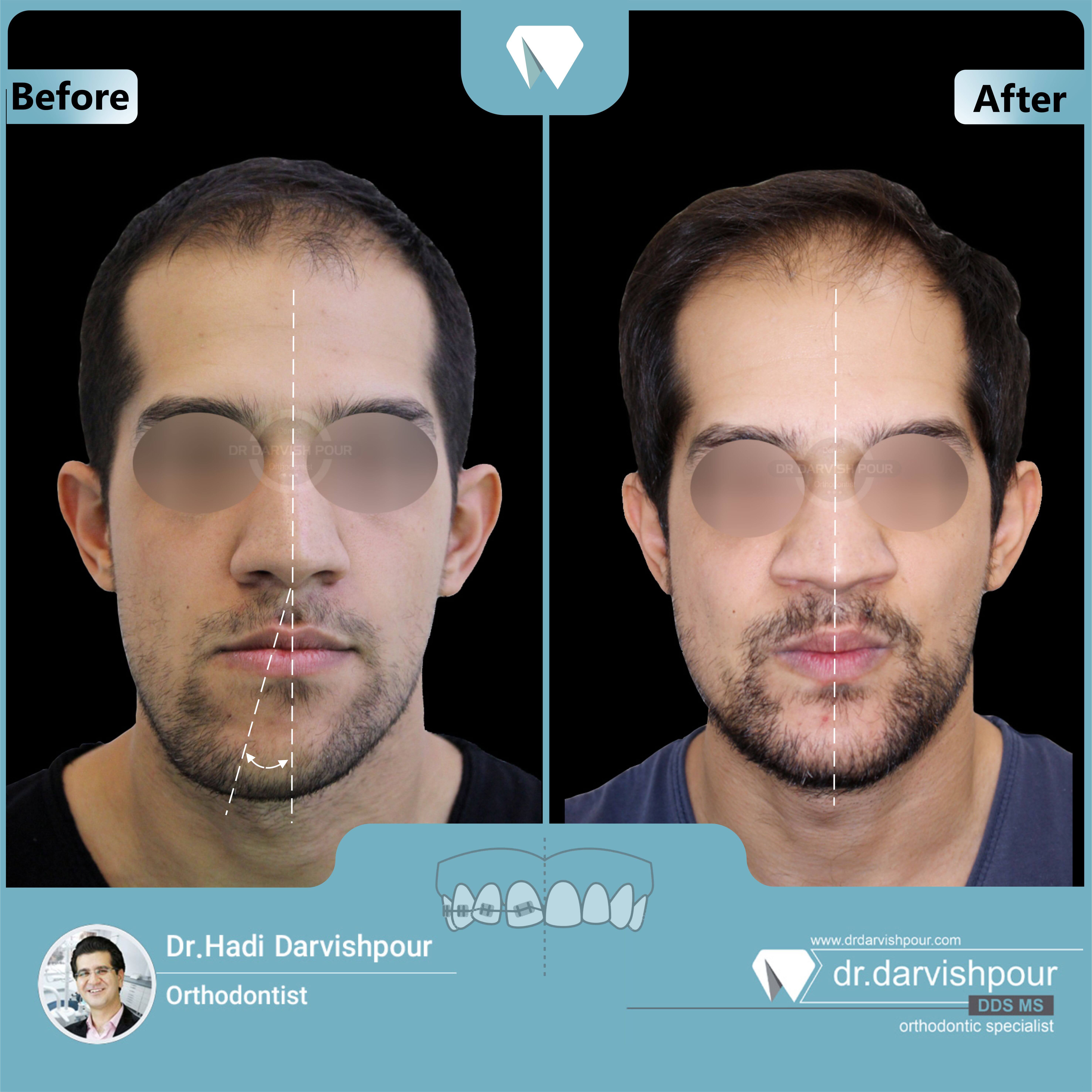 1647orthodontics-before-after-photo