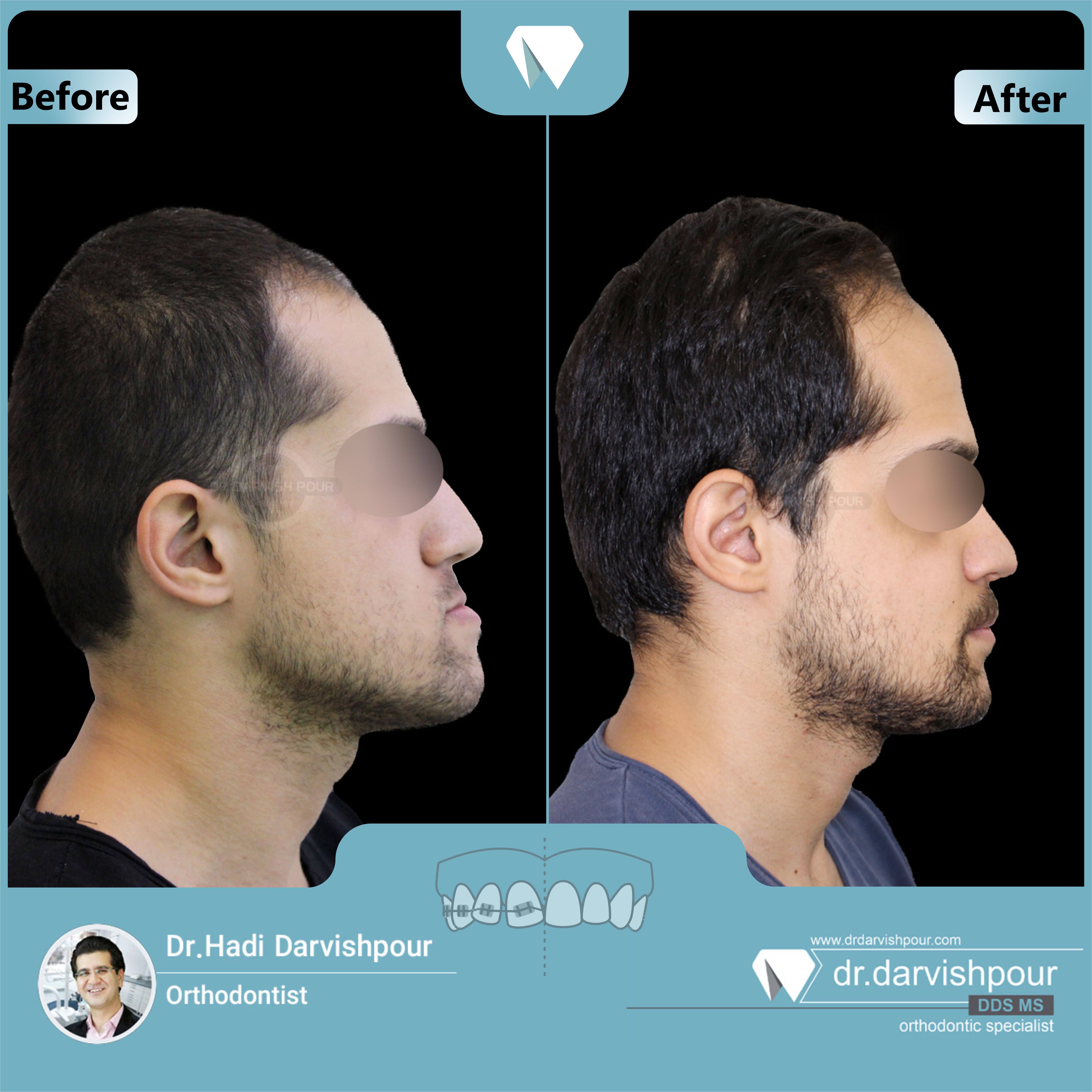 1648orthodontics-before-after-photo