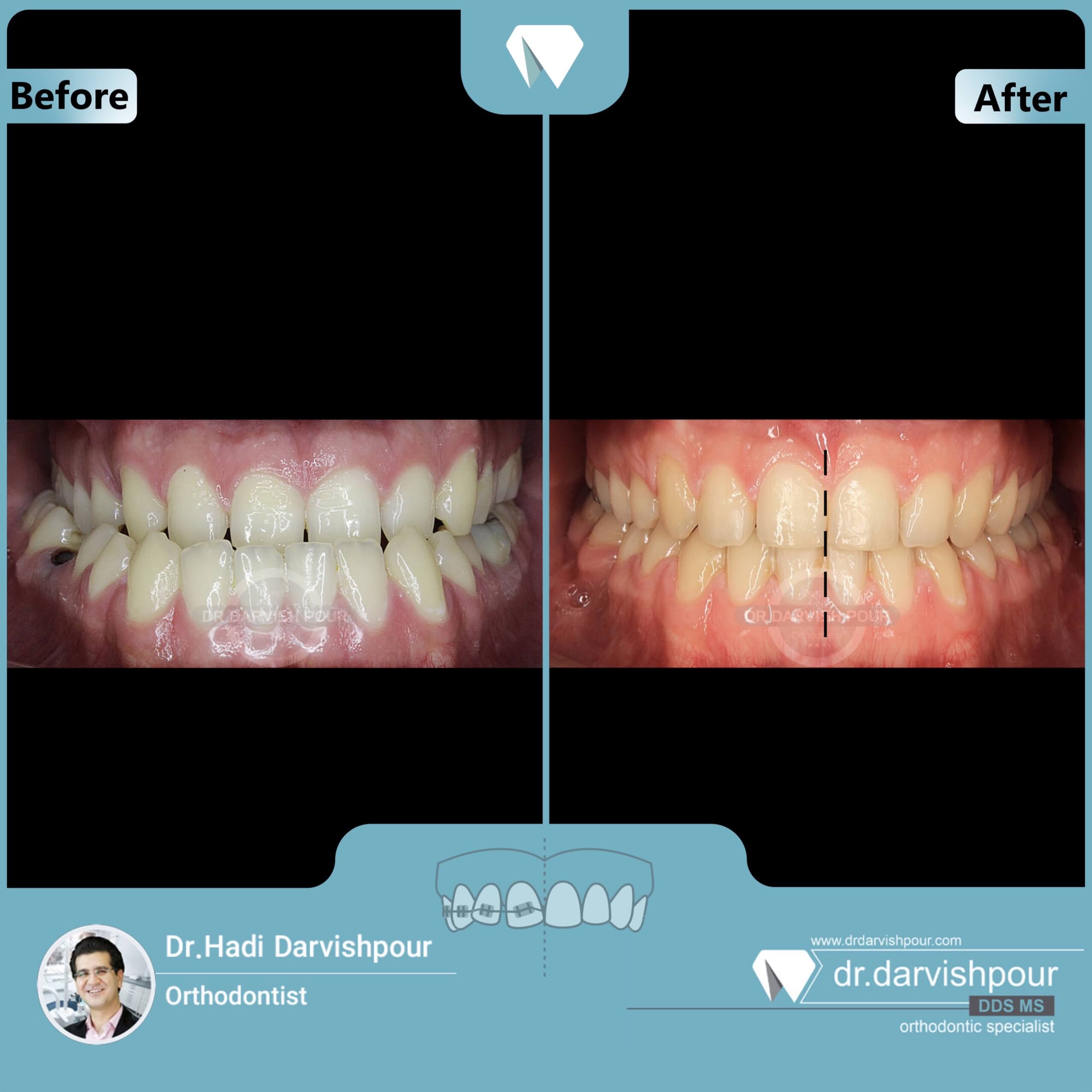 1650orthodontics-before-after-photo