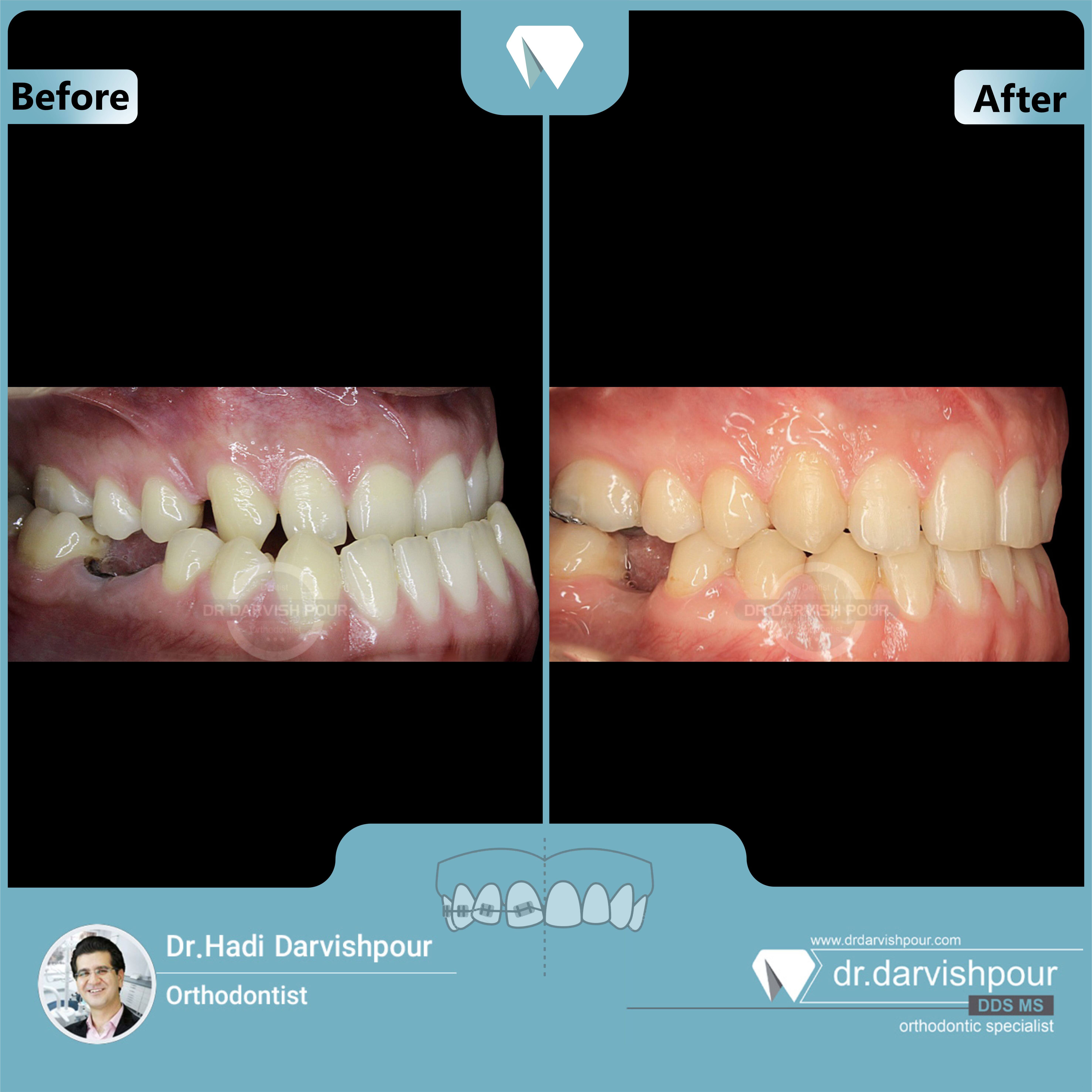 1651orthodontics-before-after-photo