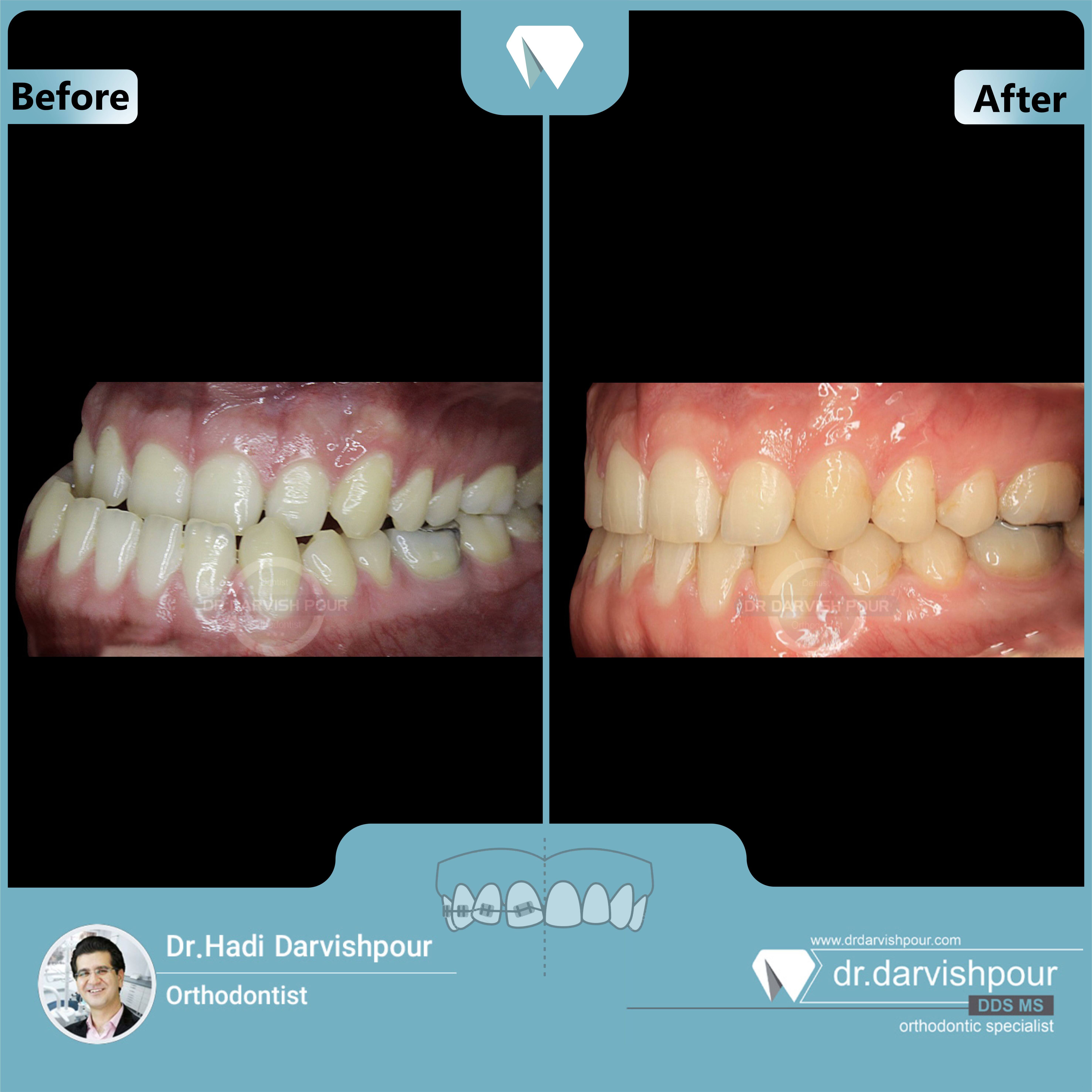 1652orthodontics-before-after-photo