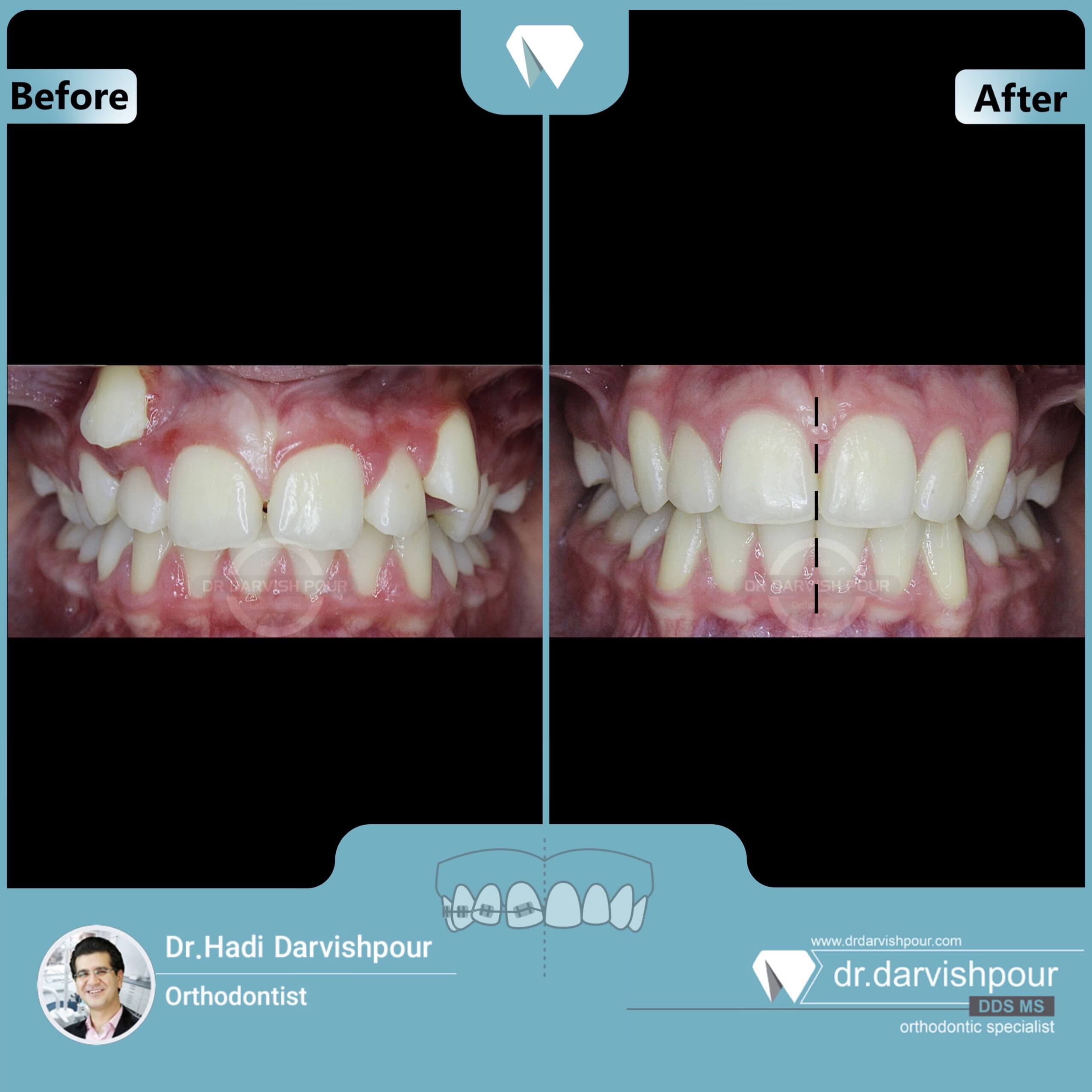 1654orthodontics-before-after-photo