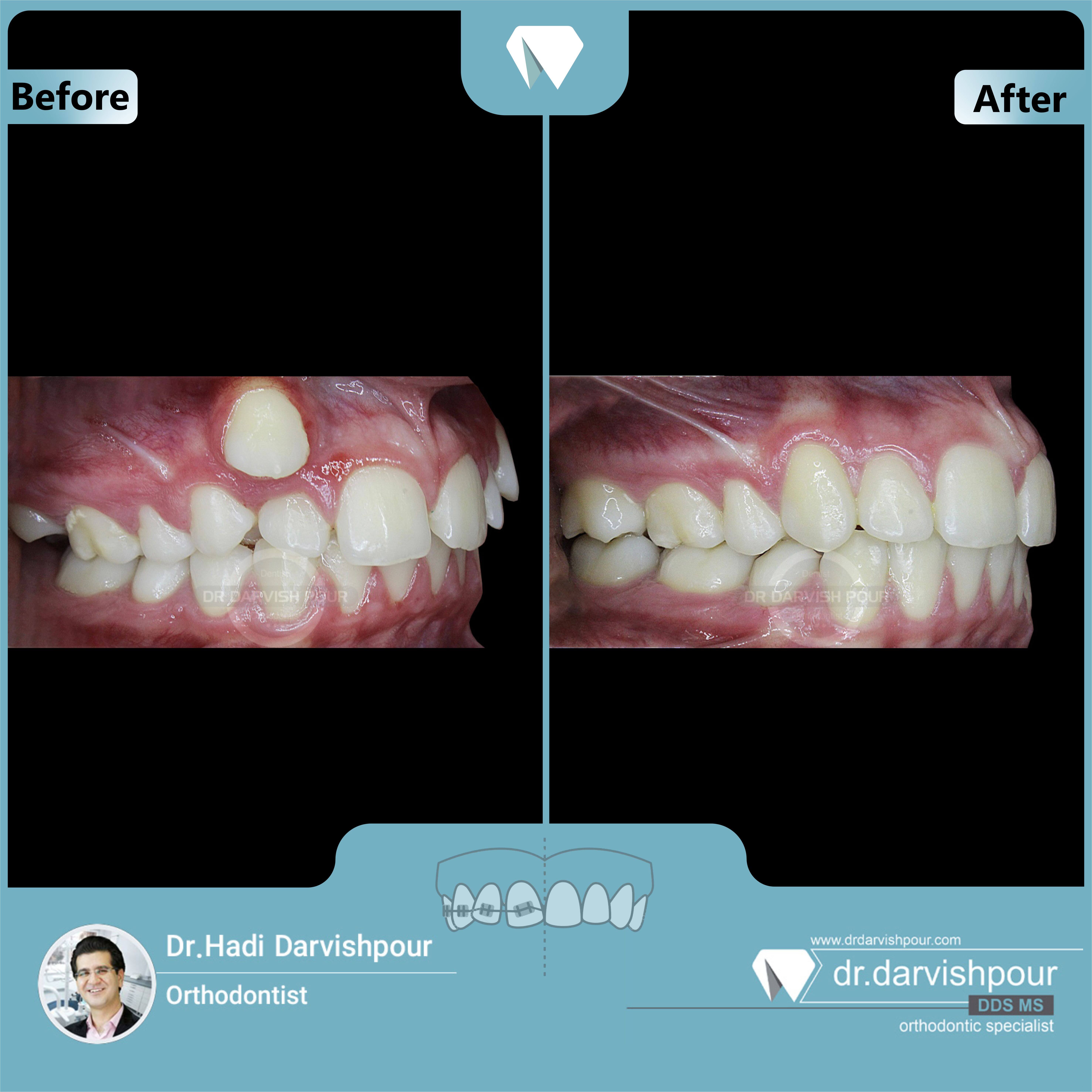 1655orthodontics-before-after-photo