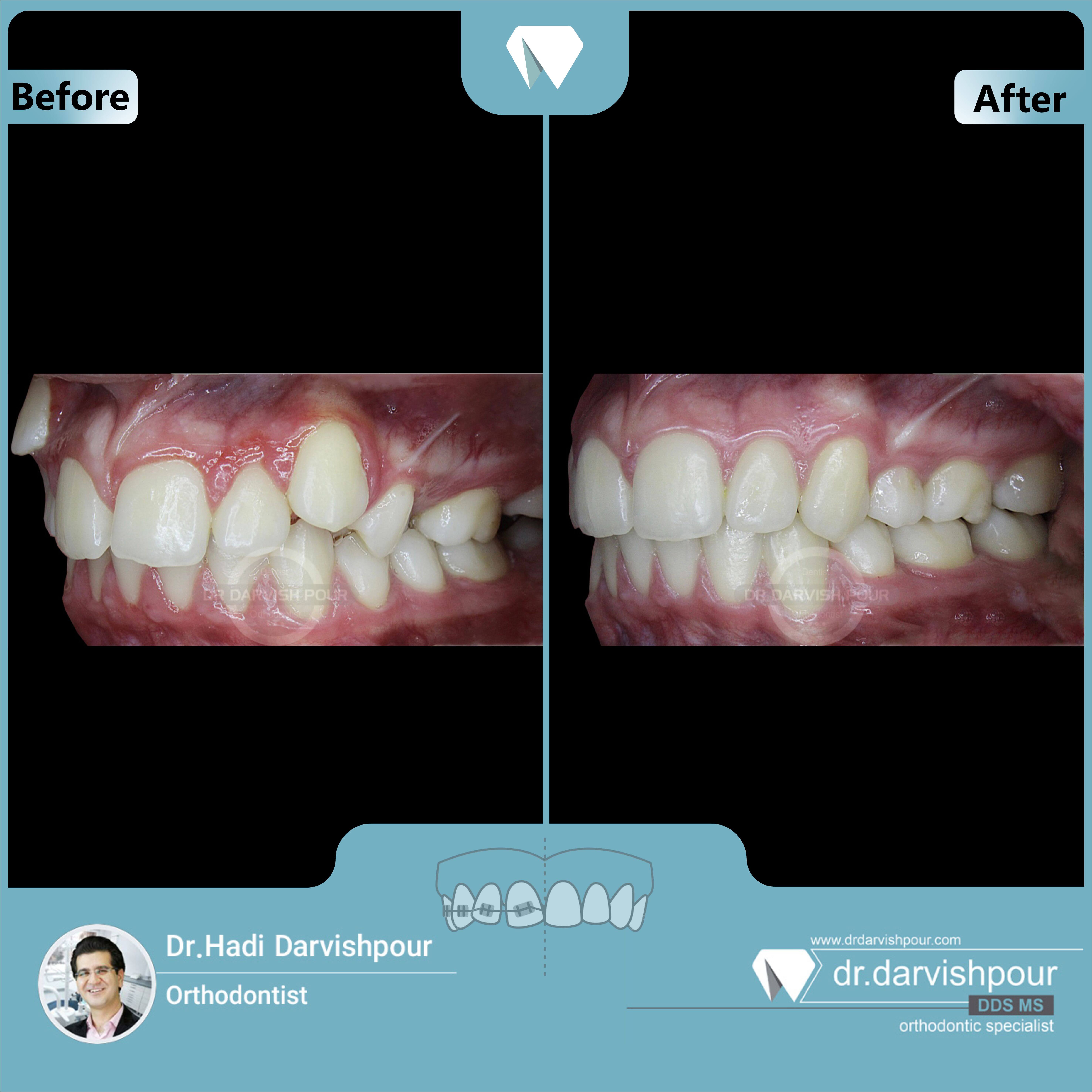 1656orthodontics-before-after-photo