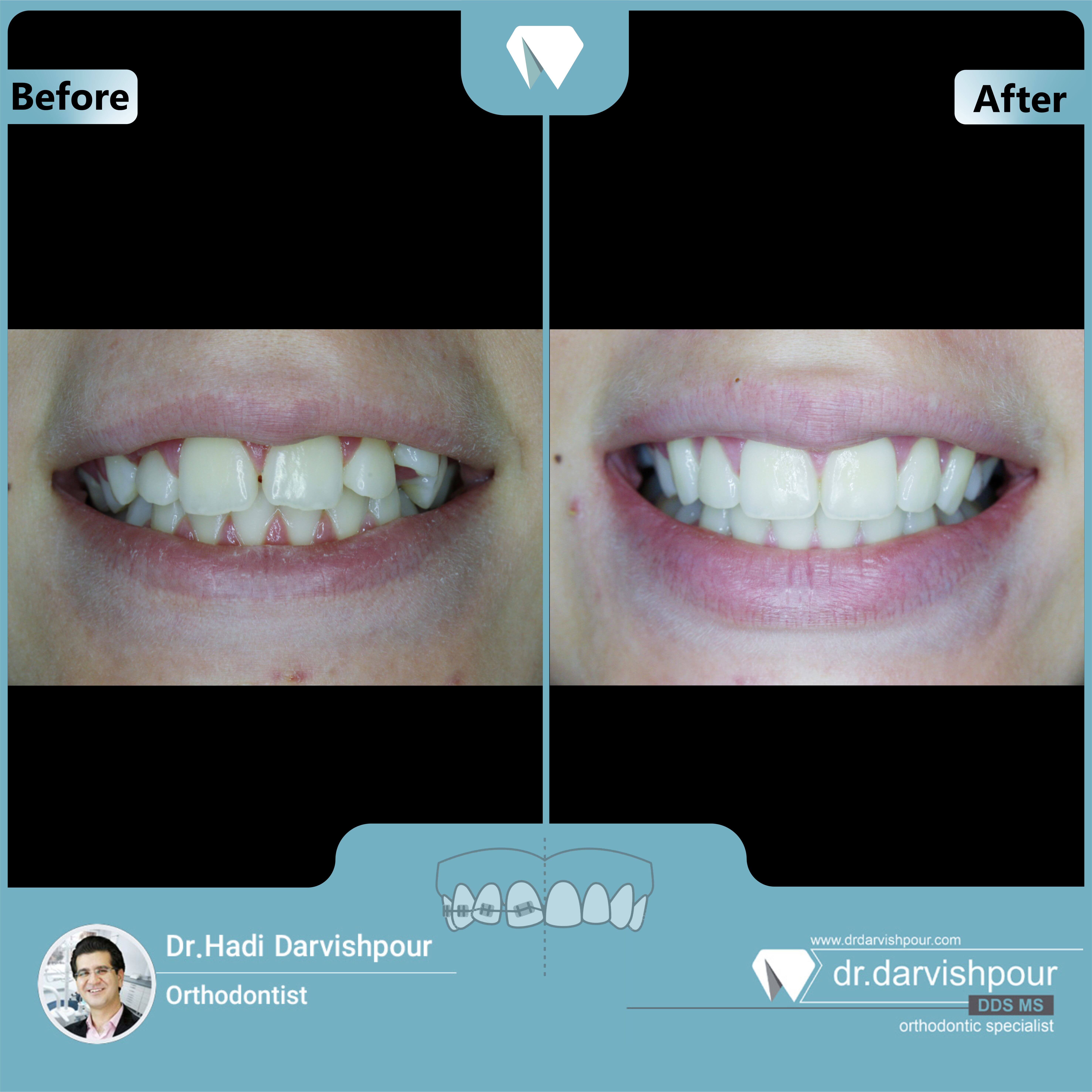1657orthodontics-before-after-photo