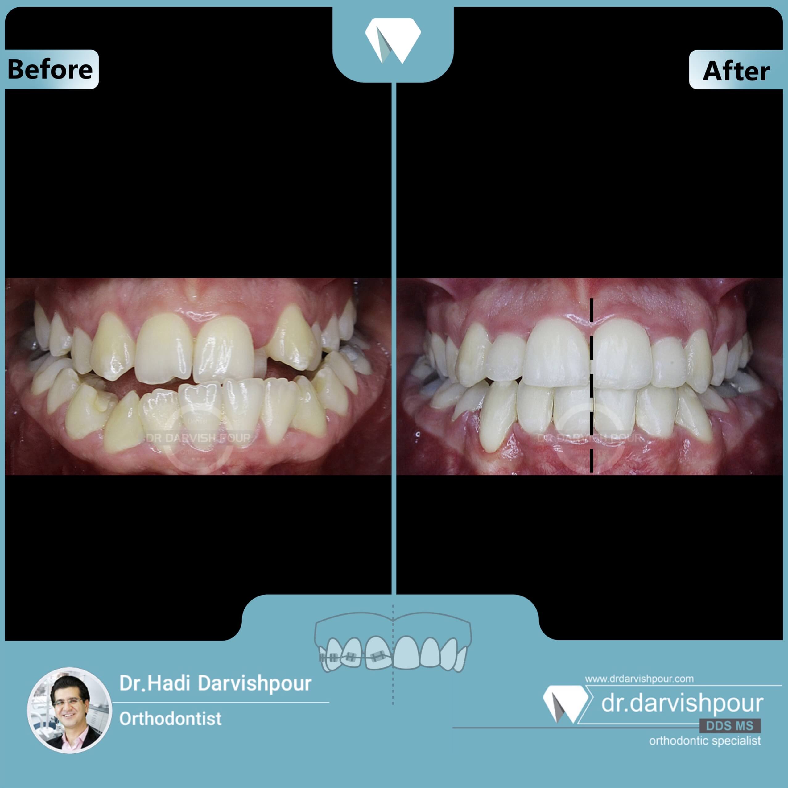 1664orthodontics-before-after-photo