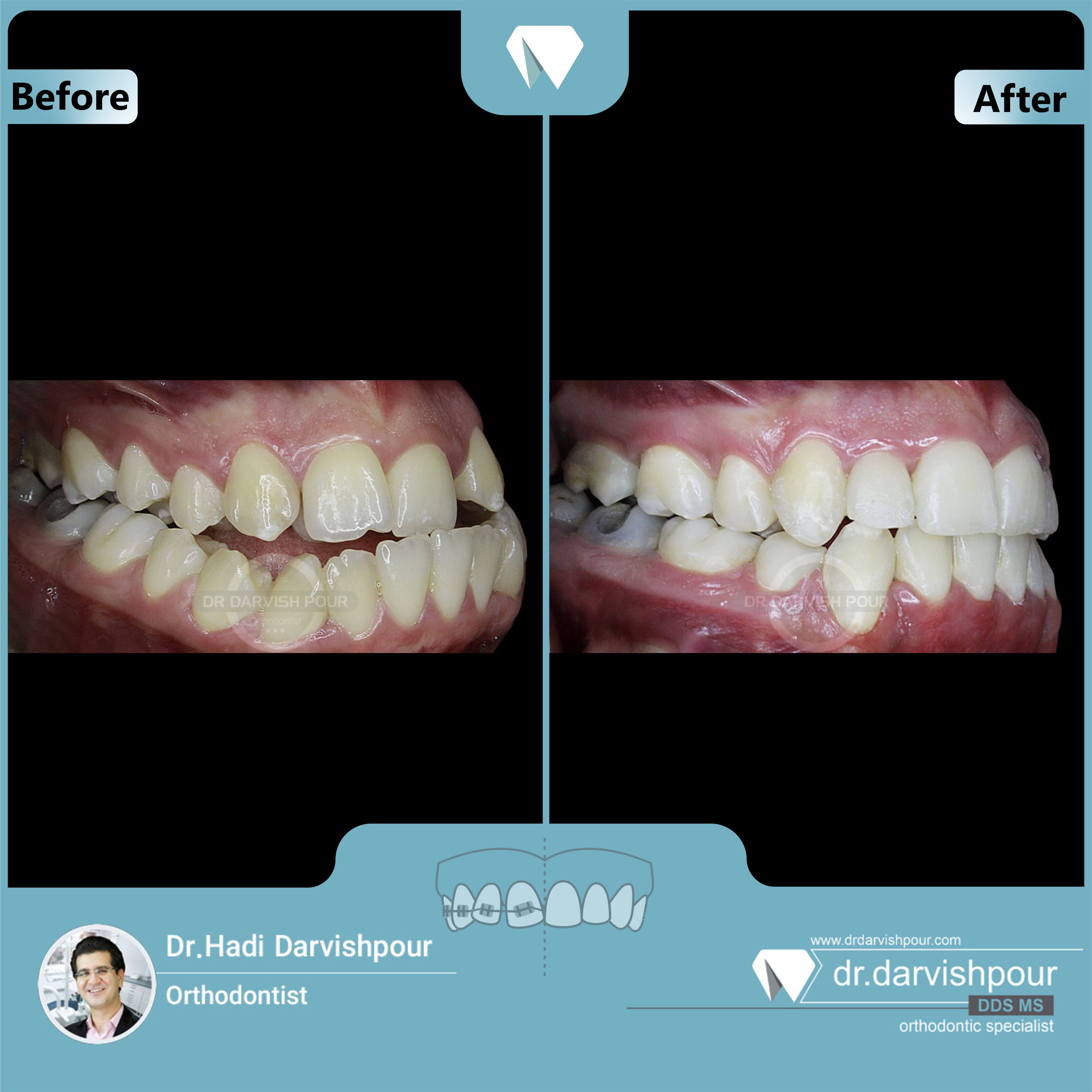 1665orthodontics-before-after-photo