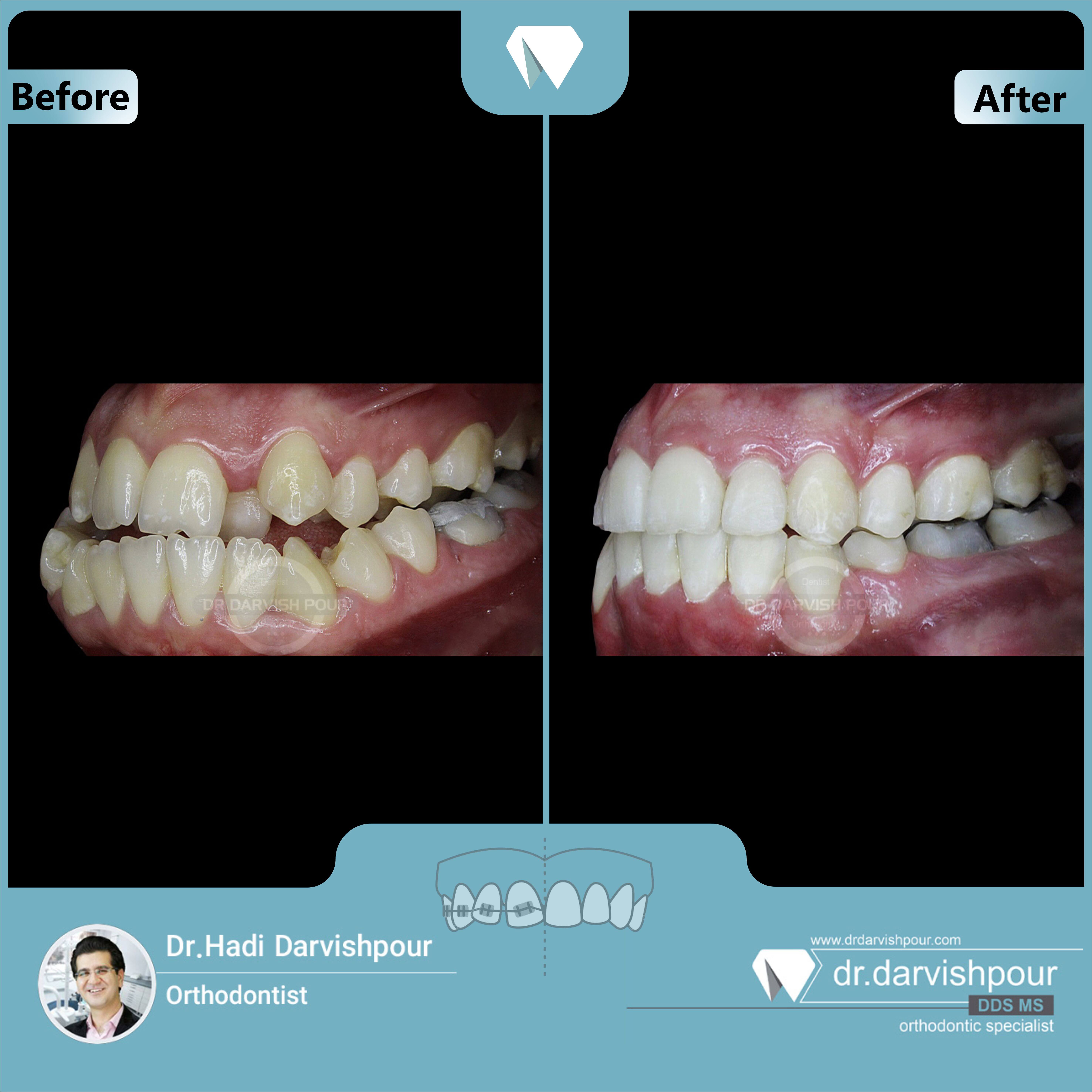 1666orthodontics-before-after-photo