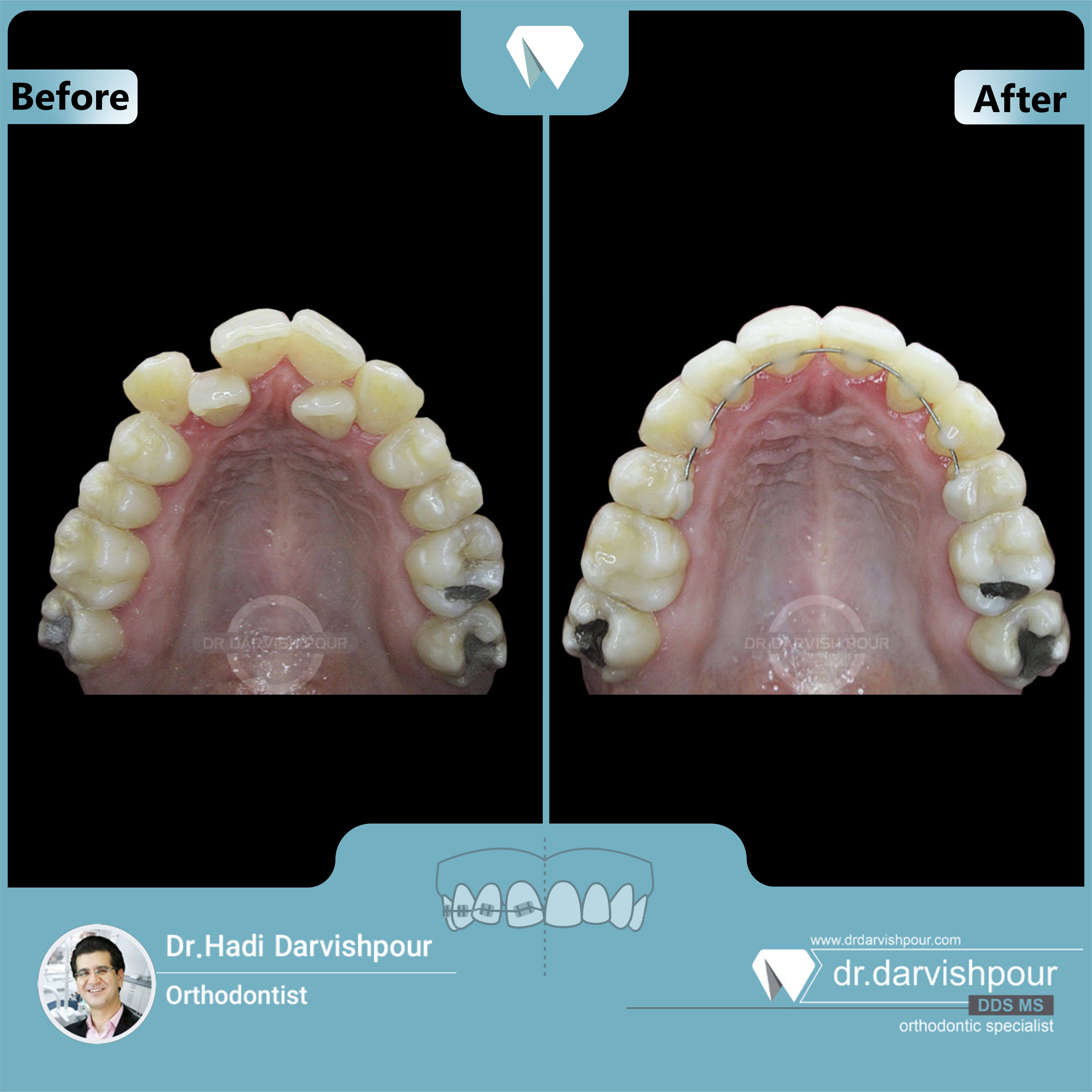 1667orthodontics-before-after-photo