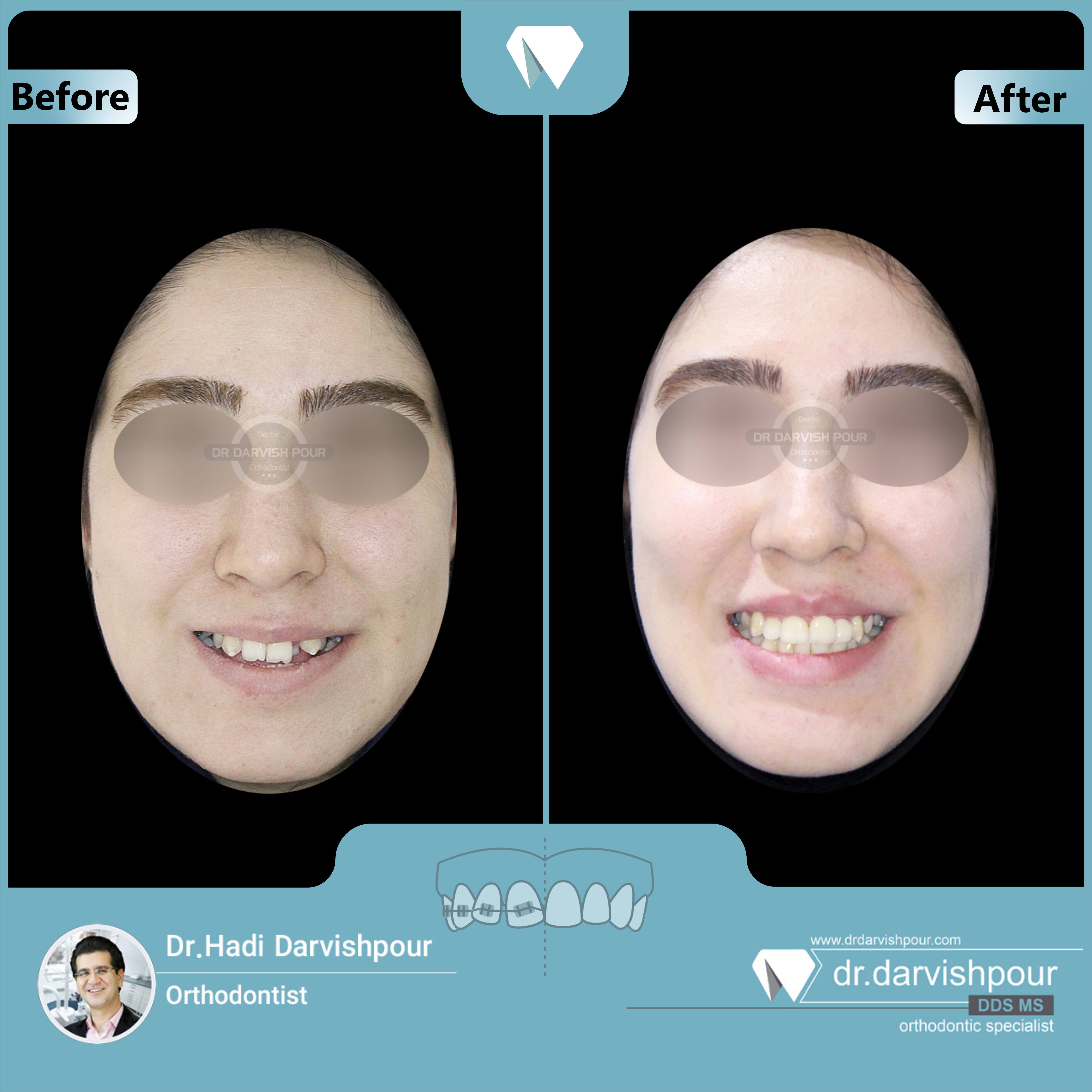 1668orthodontics-before-after-photo