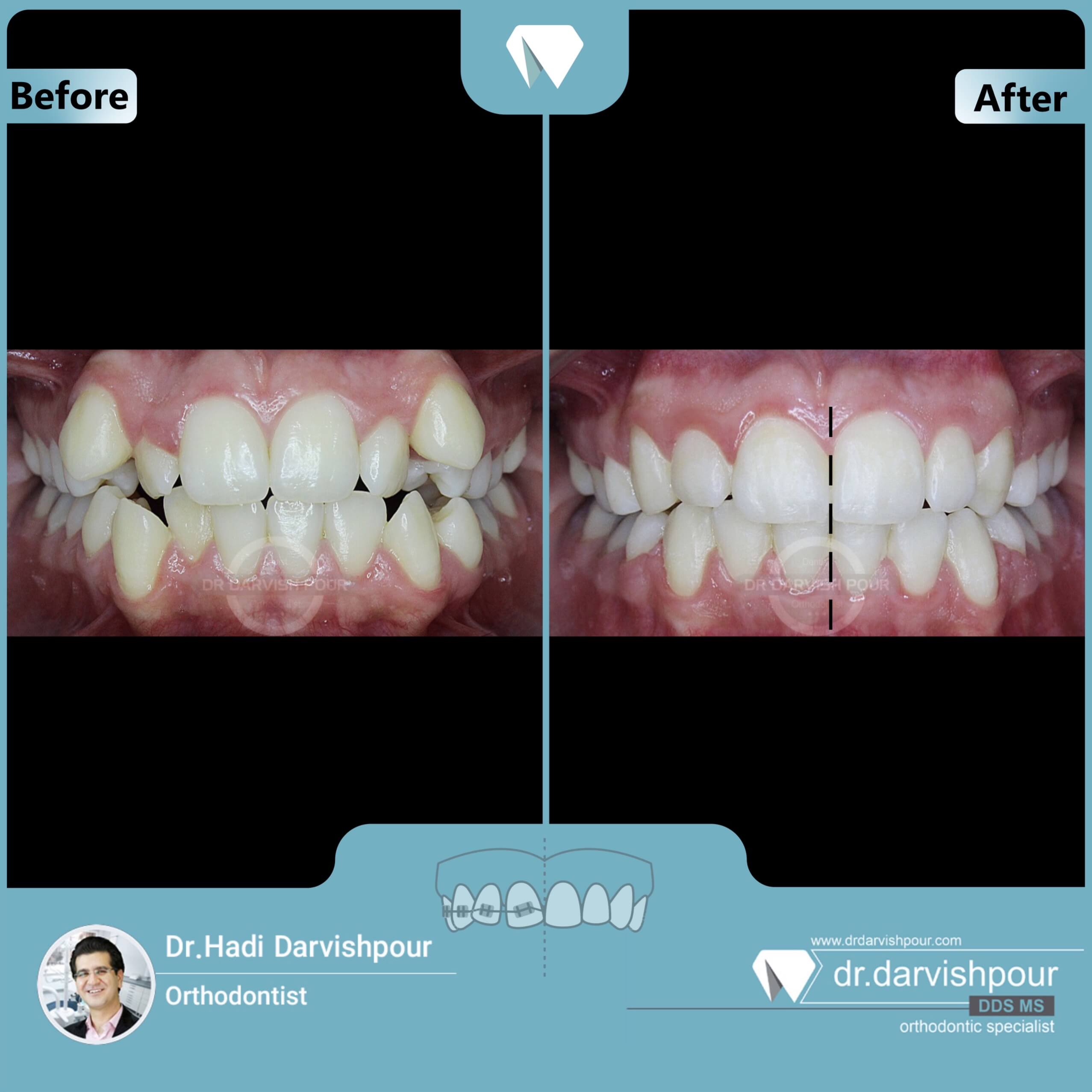 1670orthodontics-before-after-photo