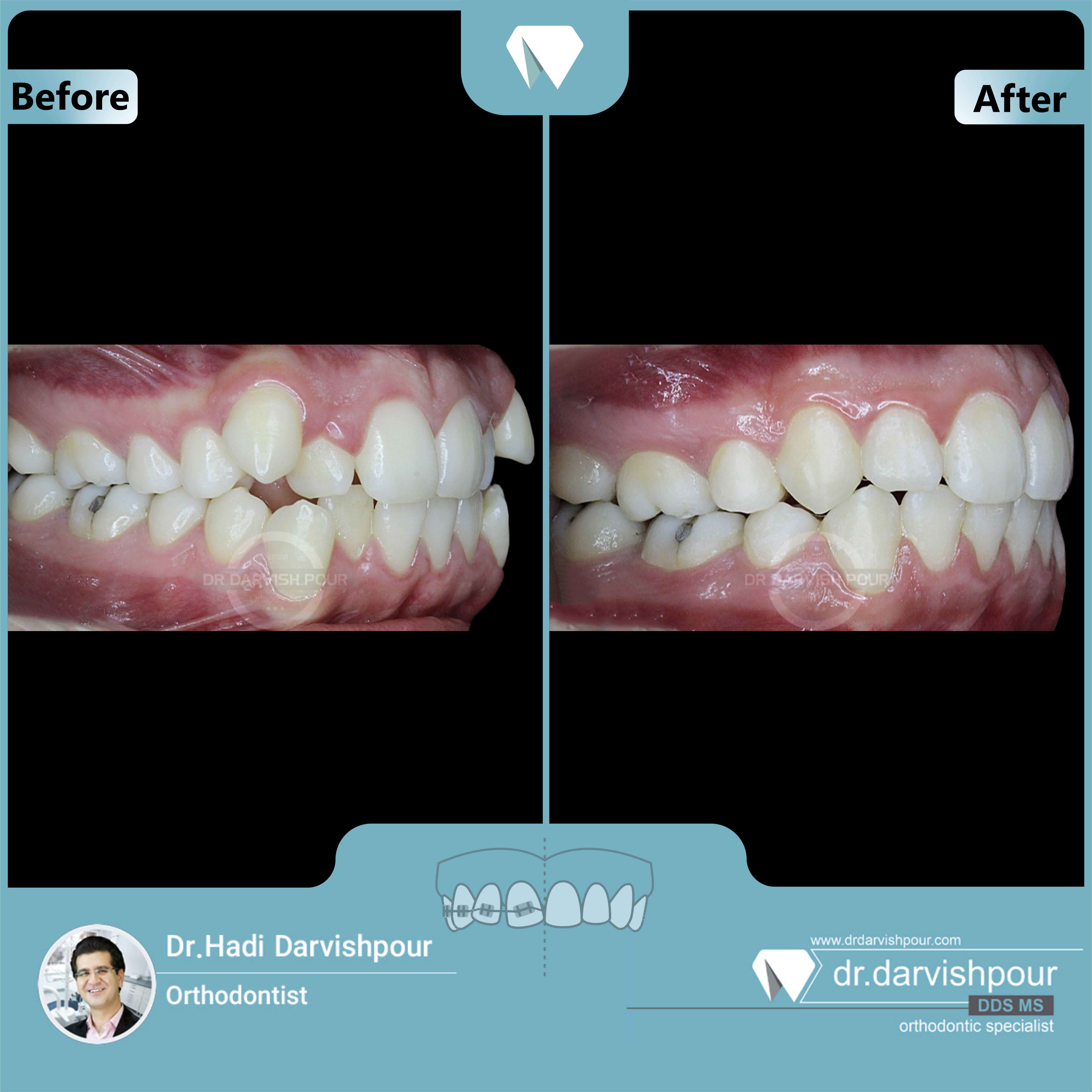 1671orthodontics-before-after-photo