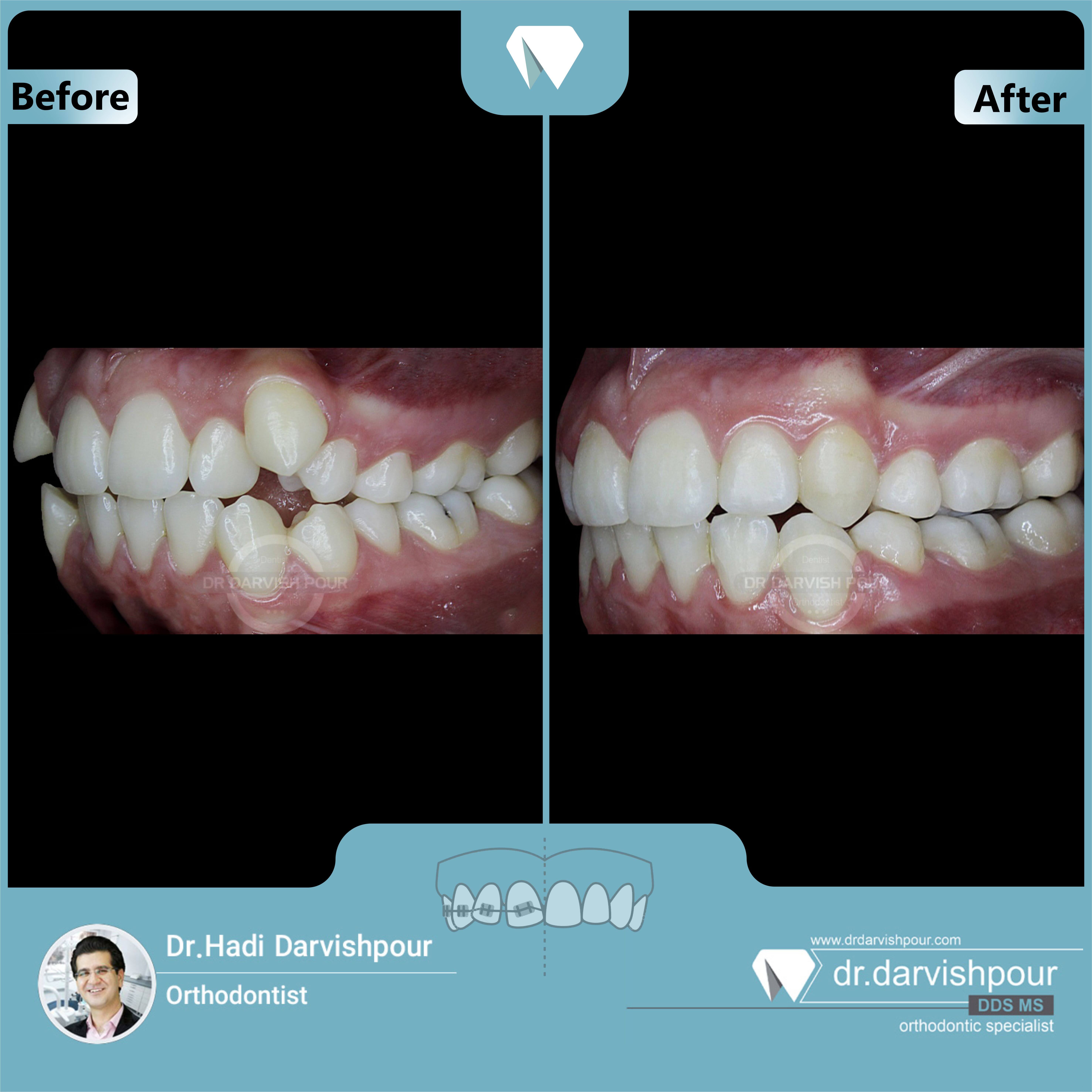 1672orthodontics-before-after-photo