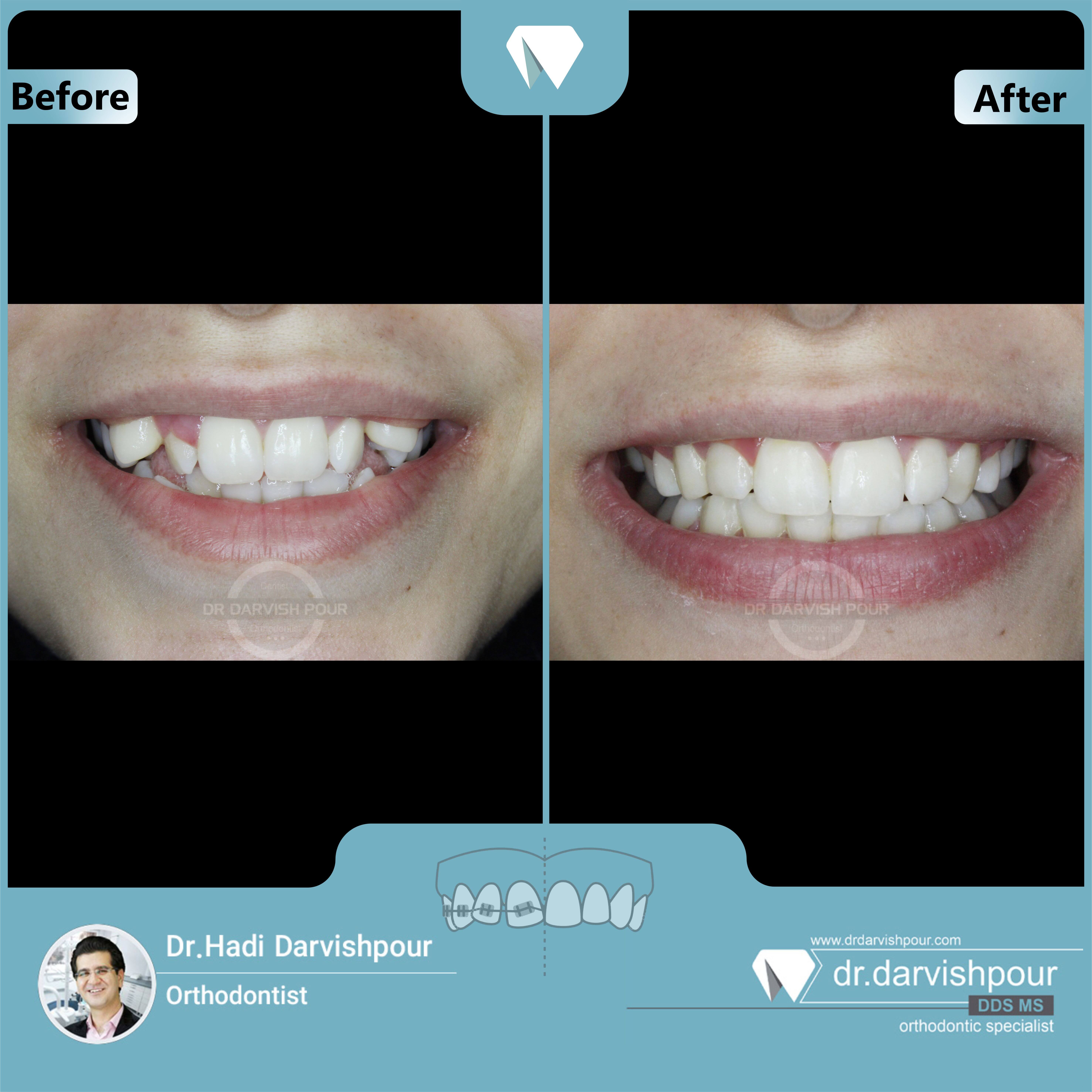 1673orthodontics-before-after-photo