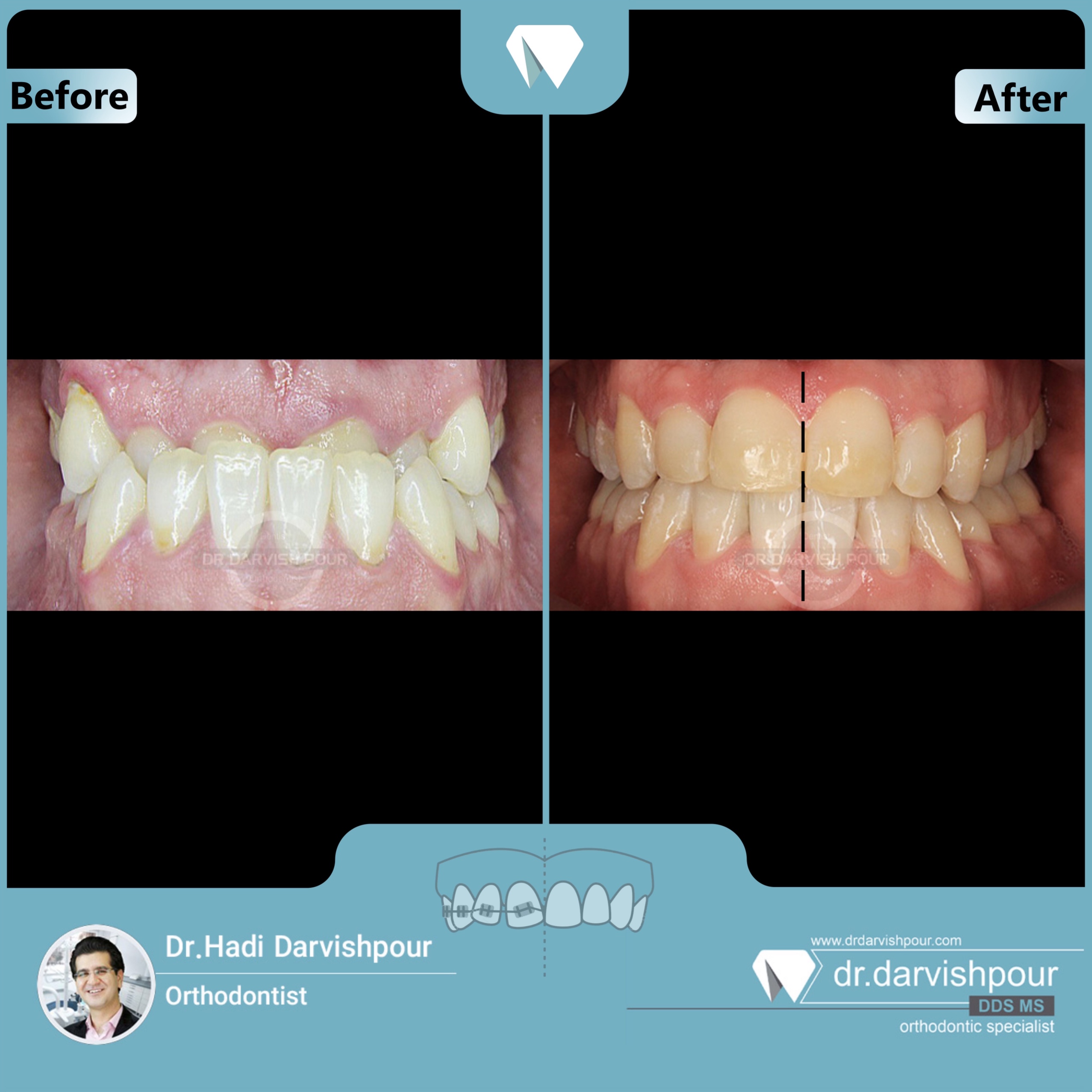 1675orthodontics-before-after-photo
