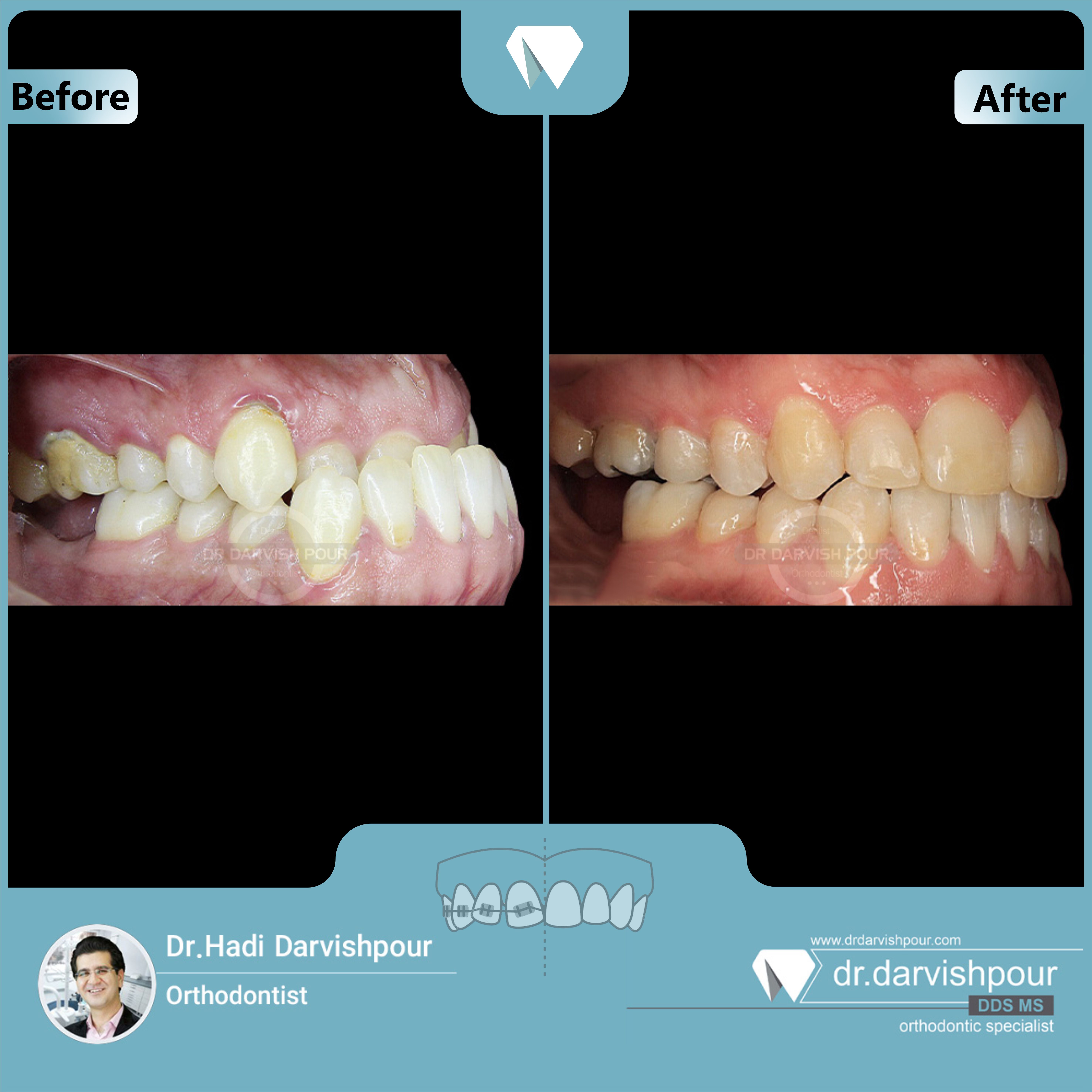 1676orthodontics-before-after-photo