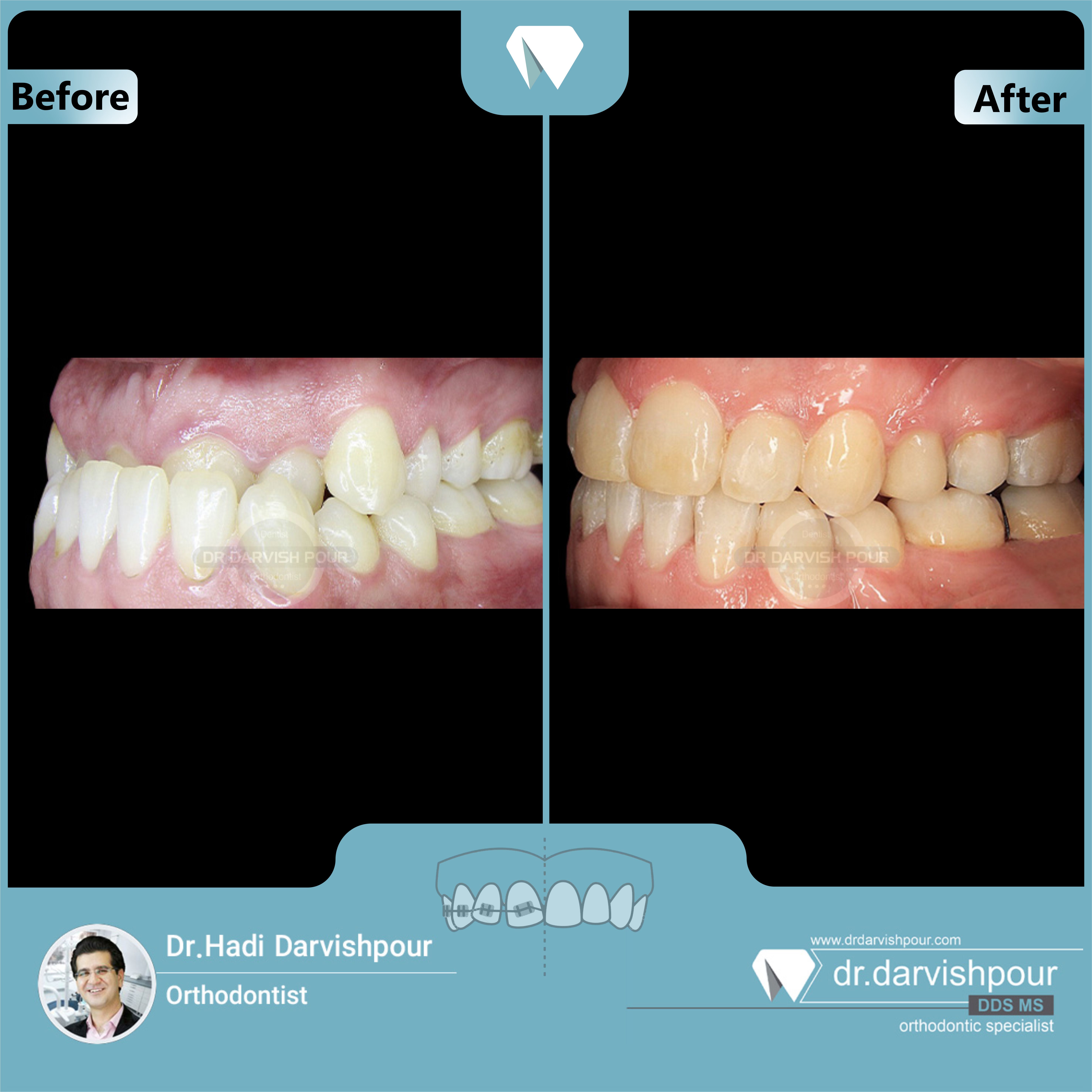 1677orthodontics-before-after-photo