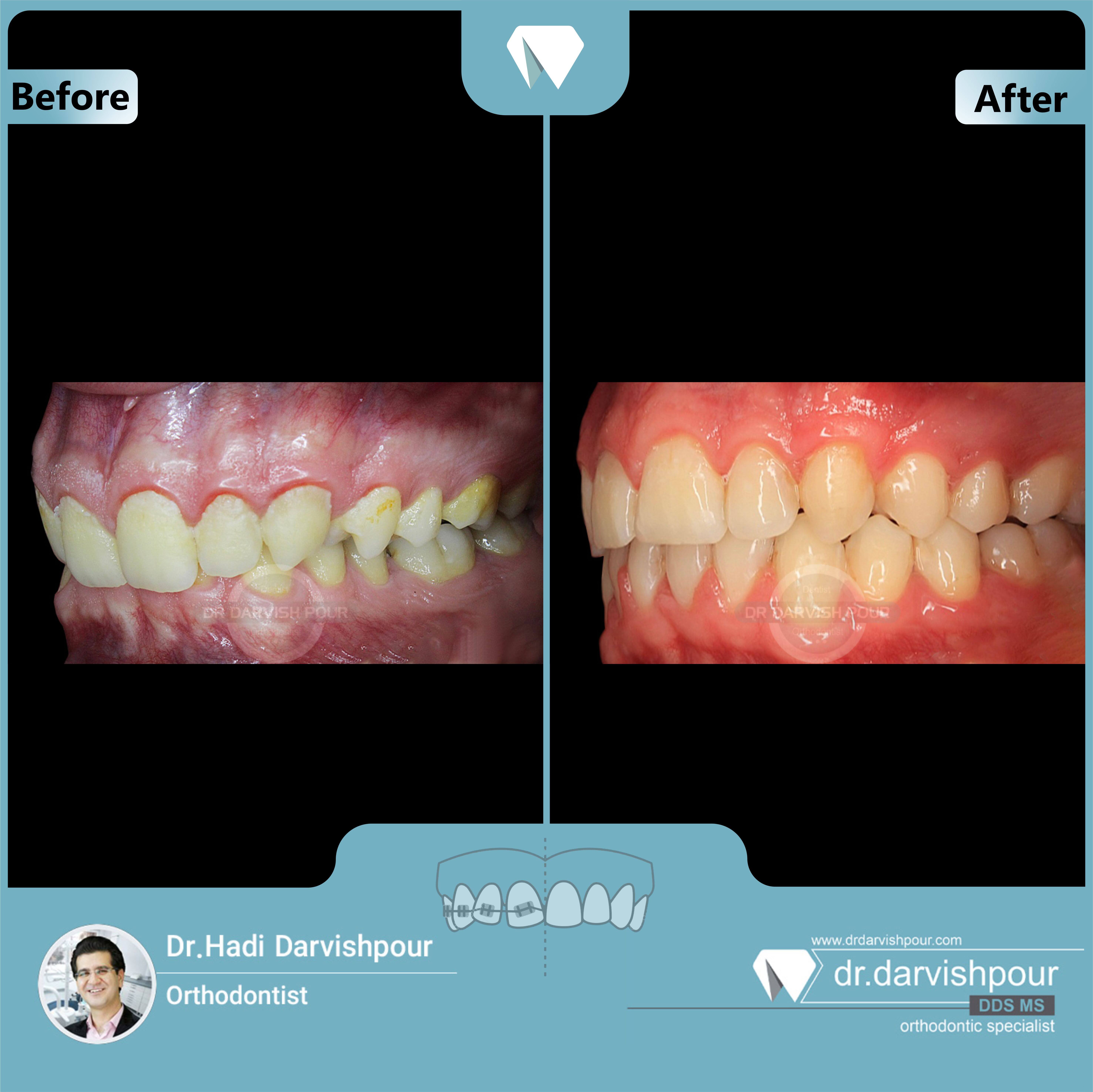 1680orthodontics-before-after-photo