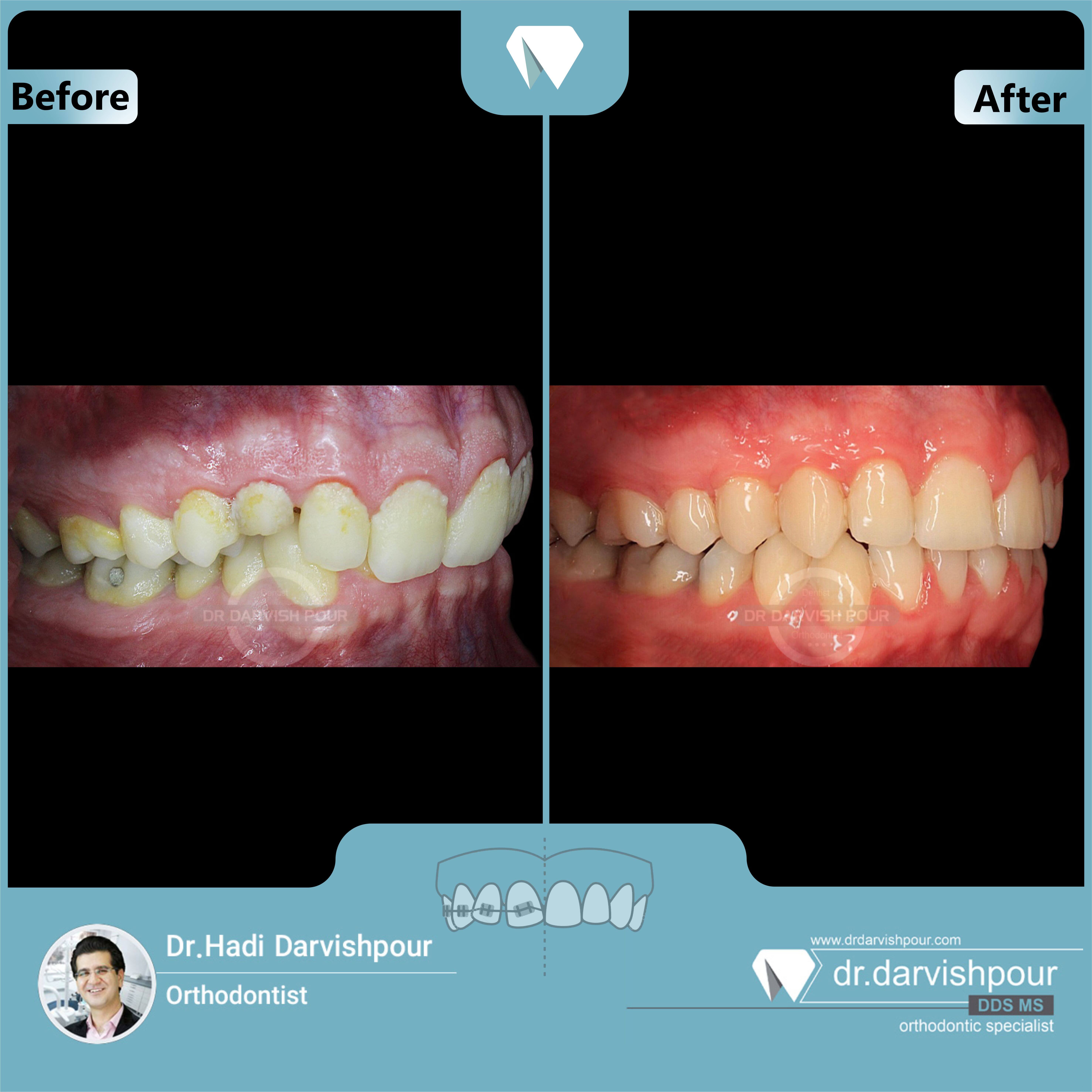 1681orthodontics-before-after-photo