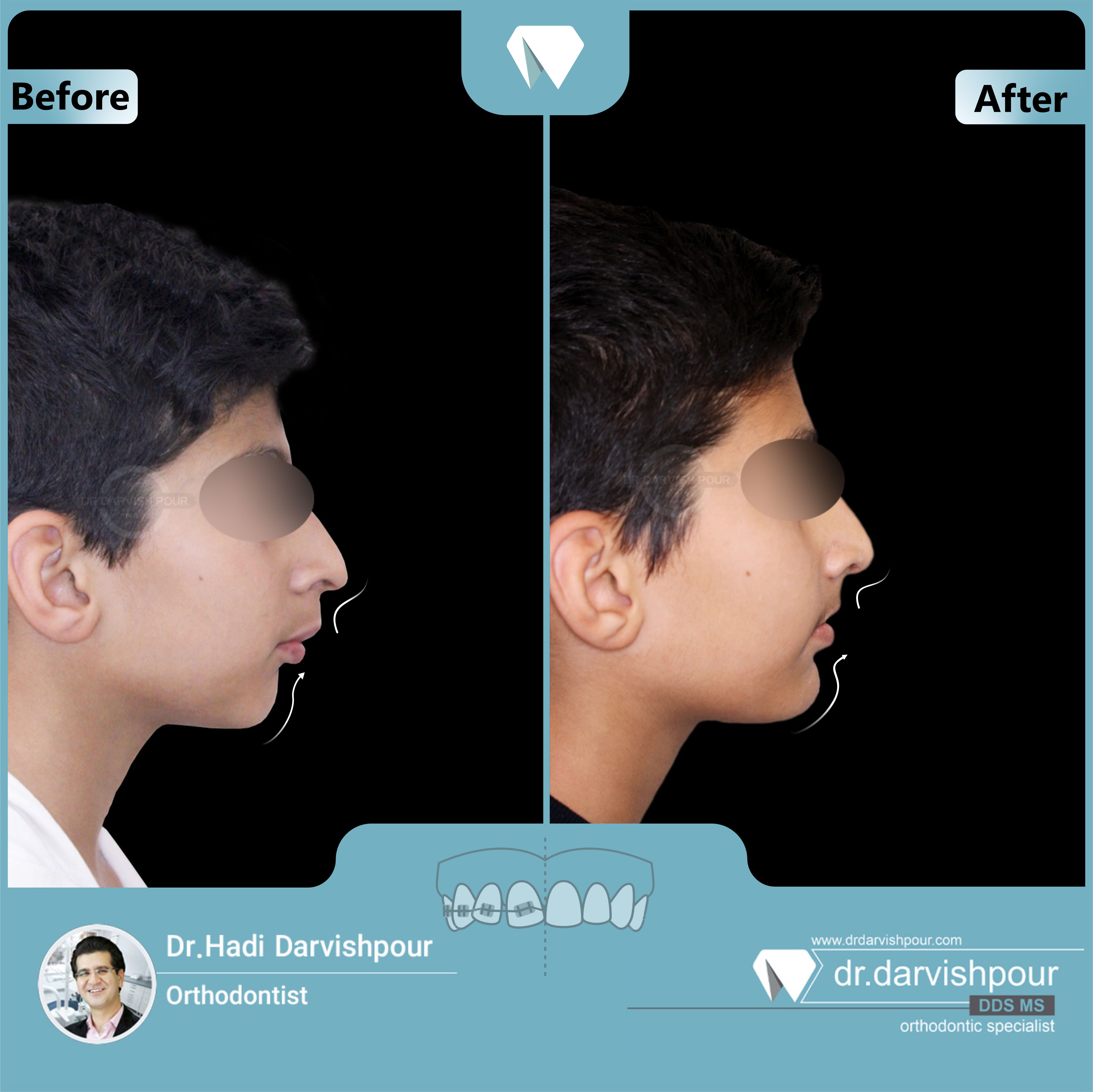1683orthodontics-before-after-photo