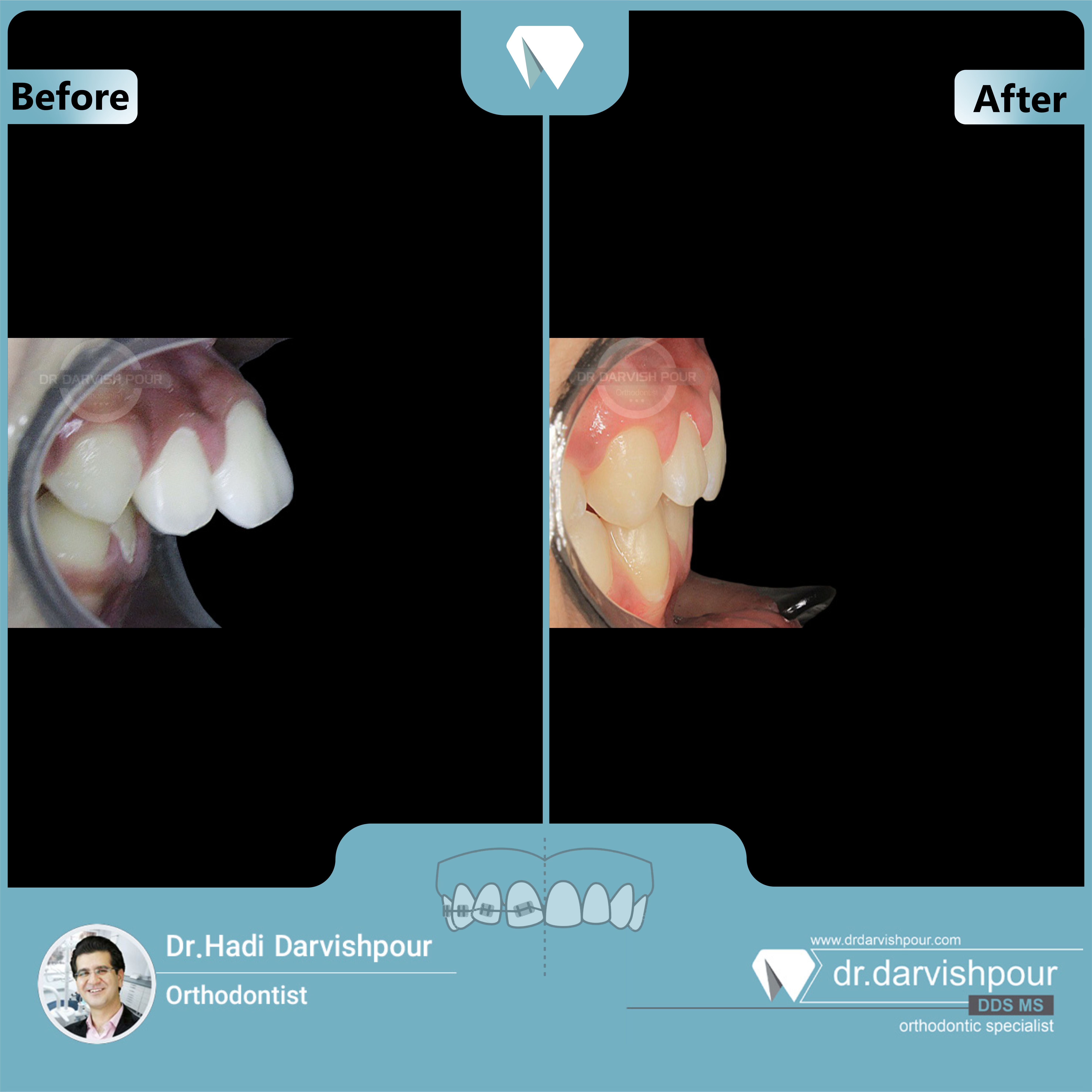 1684orthodontics-before-after-photo